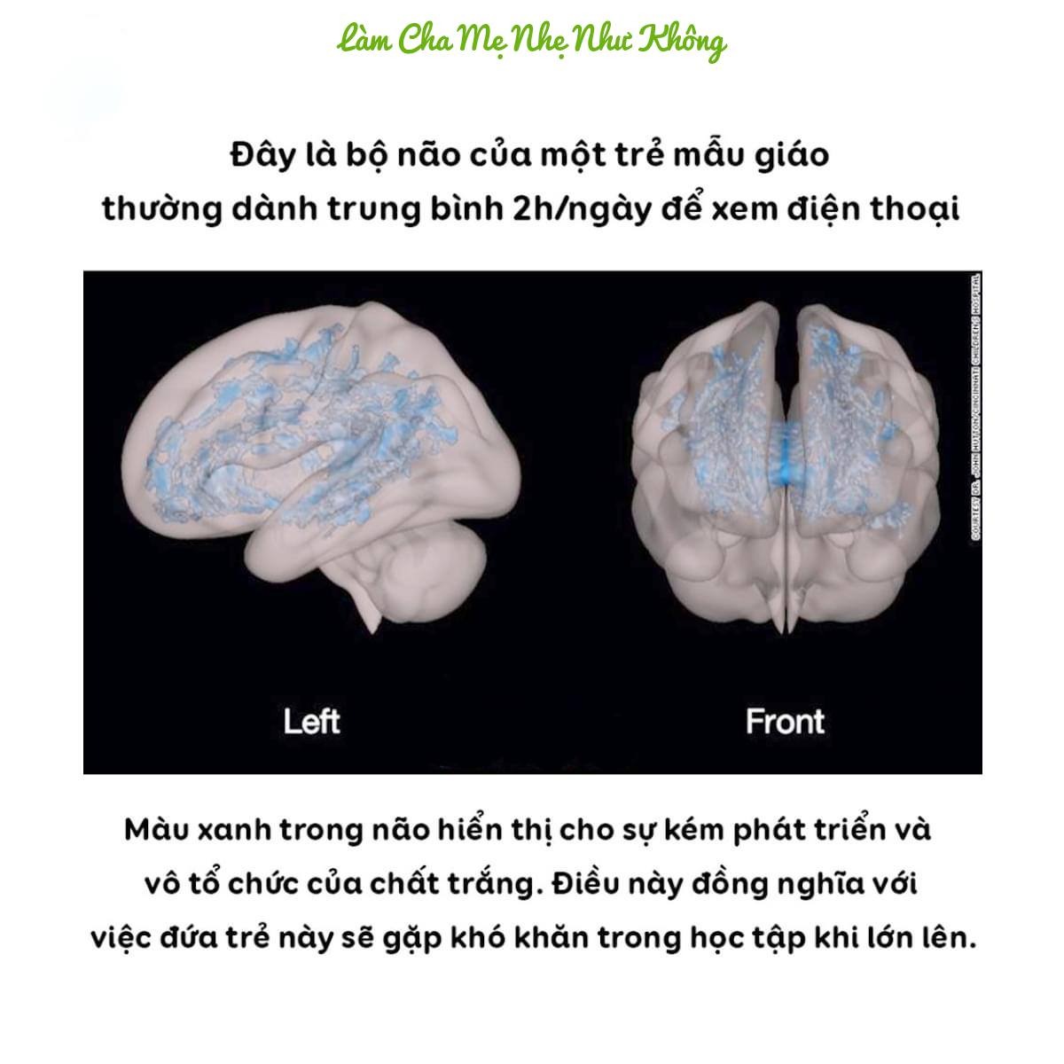SỰ KHÁC BIỆT VỀ HÌNH ẢNH QUÉT NÃO BỘ CỦA MỘT ĐỨA TRẺ HAM ĐỌC SÁCH VÀ MỘT ĐỨA TRẺ THÍCH CHƠI ĐIỆN THOẠI

👉 Phụ huynh, xin đừng khiến tương lai của con mình khó khăn!

Nhiều bậc cha mẹ hiện nay vì công việc quá bận rộn nên không chú ý nhiều đến "việc chơi" của trẻ, không ít phụ huynh đã thoải mái "ném" cho con một chiếc Ipad hay điện thoại thông minh để con xem tránh làm phiền cha mẹ làm việc. Tuy nhiên, họ lại không biết đó chính là một trong những cách kìm hãm sự phát triển não bộ của trẻ nhỏ trong 5 năm đầu đời.

Một trong những biện pháp tốt nhất để phát triển trí não một đứa trẻ dưới 5 tuổi là đọc sách cho chúng nghe và tránh để con tiếp xúc nhiều với điện thoại thông minh. Người lớn chúng ta đều biết đó là điều đúng đắn nên làm nhưng với những hình ảnh được đưa ra từ khoa học này, chắc chắn chúng ta còn càng bị thuyết phục hơn.

👉 Trong hình ảnh quét não bộ của một trẻ mẫu giáo thường xuyên được bố mẹ đọc sách cho nghe, các khu vực màu đỏ cho thấy sự tăng trưởng về chất trắng có tổ chức chứng tỏ đứa bé này có khả năng ngôn ngữ và khả năng đọc viết tốt, hỗ trợ rất nhiều cho việc học ở trường sau này.

👉 Trong hình ảnh quét não bộ của một trẻ bộ não của một trẻ mẫu giáo thường xuyên dành 2 giờ mỗi ngày để xem điện thoại. Các khu vực màu xanh cho thấy sự kém phát triển và vô tổ chức của chất trắng, tức là đứa trẻ này sẽ gặp khó khăn trong việc học sau này.
Cả hai kết quả nghiên cứu đều sử dụng thông qua phương pháp chụp cộng hưởng từ (MRIs) đặc biệt bằng cách kéo căng khuếch tán hình ảnh. Trong nghiên cứu này đã có 47 trẻ dưới 3 tuổi, chưa đi học mẫu giáo, có thể chất khoẻ mạnh tham gia.

Việc tăng và tổ chức chất trắng rất quan trọng đối với khả năng giao tiếp của một đứa trẻ. Nếu không có một hệ thống giao tiếp phát triển tốt, tốc độ xử lý của não sẽ chậm lại và việc học của trẻ bị ảnh hưởng ít nhiều.

Ngoài việc quét não, những đứa trẻ tham gia vào nghiên cứu cũng được kiểm tra nhận thức. Các nhà nghiên cứu chỉ ra những đứa trẻ sử dụng màn hình hơn 1 giờ mỗi ngày có kỹ năng đọc viết kém hơn, khả năng sử dụng ngôn ngữ biểu cảm ít hơn và khả năng gọi tên các đối tượng thấp hơn. Ngược lại, những đứa trẻ thường xuyên đọc sách với bố mẹ đạt điểm cao hơn trong các bài kiểm tra nhận thức.

"Chúng tôi thấy được những mặt không tốt từ việc xem điện thoại thường xuyên lên một đứa trẻ, cụ thể là ảnh hưởng đến khả năng ngôn ngữ, đọc hiểu của trẻ. Mặt khác, những hoạt động có lợi cho các phần khác nhau của não bộ, kích thích trí tưởng tượng như chơi đồ chơi, đi ra ngoài khám phá thiên nhiên sẽ phù hợp với một trẻ mẫu giáo hơn là ngồi trước màn hình điện thoại", Tiến sĩ Hutton - bác sĩ Nhi khoa & Nhà nghiên cứu lâm sàng tại Bệnh viện Trẻ em Cincinnati bày tỏ.

-----------------------

Đọc sách cho con như thế nào mới tốt?

Tiến sĩ Hutton cho biết nhiều phụ huynh loay hoay và áp lực đi tìm một cuốn sách hoàn hảo để đọc cho con. Nhưng thực tế, chẳng có cách đọc nào tốt nhất cả. Hãy đọc sách cho con với một tình yêu thương bao la và sự kiên nhẫn của một bậc làm cha làm mẹ cần phải có.
Dưới đây là một số lời khuyên dành cho các bậc phu huynh để thu hút và lôi kéo con bạn yêu thích sách và đọc sách nhiều hơn:

✔ Thường xuyên trò chuyện với con.
✔ Hát những bài hát thiếu nhi.
✔ Cho con được thoả trí tưởng tượng sáng tạo những câu chuyện của riêng mình và sau đó, cha mẹ nên đặt nhiều câu hỏi về cốt truyện để kích thích con tiếp tục tưởng tượng.
✔ Cha mẹ nên chọn đọc những cuốn sách có nhân vật thú vị và đừng ngại nhập vai hay biểu cảm bằng các giọng đọc khác nhau dành riêng cho mỗi nhân vật.
✔ Cho con chỉ vào tranh hoặc từ rồi lặp đi lặp lại từ đó.

Điều cuối cùng và quan trọng nhất: Bố mẹ nên thư giãn chính mình để giáo dục con tốt hơn!