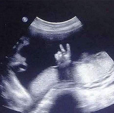 👉Các mẹ đang mai thai nhớ nhé :

Khi chính thức biết mình mang thai rồi nhớ đi nhẹ, nói khẽ, cười duyên. Tránh đi xa, tránh đi đường dằn xốc. Tránh leo cầu thang, với cao, kiễng chân, mang vác nặng.

-Giảm áp lực tinh thần khi mang thai. Tránh nóng giận, bực mình, nên luôn tạo tâm trạng thoải mái vui vẻ sẽ tốt hơn cho con. Tránh đọc sách báo, xem tin tức rùng rợn, giật gân, sẽ làm ảnh hưởng đến tinh thần mẹ và bé

👉Về vấn đề Thực Phẩm:

-Kiêng đu đủ, rau răm, rau ngót, rau sam, nước dừa, cam thảo và các loại nước mát. Kiêng ăn trái Sơn Trà, vì sẽ gây co thắt tử cung dễ sinh non. Không ăn trái đào và long nhãn vì dễ gây xuất huyết trong thai kì.

- Không ăn mực, cua trong 3 tháng đầu của thai kì. Không ăn vi cá mập, cá ngừ, cá thu, cá kiếm…. vì trong thịt các loại cá này có chứa hàm lượng thủy ngân cao, rất nguy hiểm cho sự phát triển của thai nhi. Thức hiện phương châm, ăn chín, uống sôi để tránh nguy cơ nhiễm giun, sán.

- Không ăn các thức ăn có sử dụng phèn chua như Quẩy, các món dưa muối chua…. Vì sẽ làm ảnh hưởng đến sự phát triển não bộ của thai nhi.

-Tránh các món ăn gây nặng bụng, các món chiên, xào nhiều dầu mỡ, không ăn các món ăn quá béo. Tránh các món nướng, xông khói, các món ăn có quá nhiều các loại gia vị.

-Tránh ăn ngải cứu nhất là khi đang động thai. Ngải cứu có thể làm sẩy thai ngay lập tức.

-Kiêng ăn mặn để tránh phù thủng, tăng huyết áp đột ngột làm ảnh hưởng đến sức khỏe cũng như sự phát triển của thai nhi, dễ dẫn tới nhiễm độc thai nghén.

-Nếu thai phụ có tiền sử huyết áp thấp thì có thể ăn mặn 1 tí, tuy nhiên với liều lượng vừa phải.
Tránh ăn gan động vật quá nhiều vì trong gan có nhiều Vitamin A, quá liều có thể gây dị dạng thai nhi. Vitamin A trong thai kỳ không cần bổ sung nhiều ( 3 tháng đầu càng nên hạn chế, mắt thai nhi chỉ thực sự mở từ tuần 28 trở đi
và sau khi ra đời mới bắt đầu phát triển tiếp tục ). Tránh ăn đồ hộp chưa qua hâm nóng lại.

-Tránh ăn quá ngọt để tránh nguy cơ tăng cân quá mức hoặc tiểu đường cho mẹ và thai nhi.

- Trong 3 tháng đầu tránh không ăn đồ quá bổ như yến sào, gà tần (gà tiềm),…

👉Về Thức uống:

-Tránh các thứ kích thích, tránh bia rượu, thuốc lá.. Chất cồn trong rượu khi đưa vào máu có thể gây ngộ độc rượu, gây dị tật cho thai nhi, làm tăng tỉ lệ sinh non và thai chết lưu trong bụng mẹ. Thuốc lá có thể gây dị dạng thai nhi, nhất là trong 3 tháng đầu của thai kì, mẹ hút thuốc có thể làm tăng nguy cơ thai chết lưu, dị dạng hoặc sẩy sớm.

-Riêng trà, cà phê, coca, socola… thì chỉ uống khi cần thiết. Tuy nhiên với liều lượng vừa phải. Uống nhiều có thể dẫn đến nguy cơ tăng nhịp tim, tăng áp lực máu và ảnh hưởng đến sự phát triển của thai nhi, dễ dẫn đến sẩy thai và sinh non.
Về Kiêng Cữ:

-Tránh xa các thú nuôi trong nhà, như mèo, chó…Lông chó, mèo có thể gây dị ứng trong quá trình mang thai. Phân mèo có thể mang vi khuẩn Toxoplasmosis vô cùng nguy hại đối với thai nhi.

-Tránh thức khuya. Ngủ phải mắc màn, tránh bị sốt

-Tránh để táo bón. Có thể uống 1 lít nước vào buổi sáng sớm, trước khi ăn sáng để ngừa táo bón. Ăn nhiều rau quả, trái cây tươi rửa sạch.

- Không sờ đầu ti, xoa nắn ngực và bụng trong suốt thời gian mang thai vì sẽ gây co thắt tử cung, dẫn tới động thai, sẩy thai hoặc sinh sớm.

-Tránh uống thuốc Đông y trong 3 tháng đầu của thai kì. Vì thuốc bổ quá đôi khi cũng dẫn đến động thai, gây xuất huyết AĐ và sẩy sớm.

- Tránh sử dụng hoặc đứng gần lò vi sóng, bếp từ

- Hai vc nên tuyệt đối kiêng quan hệ trong thời gian đầu, ít nhất trong 1 tháng đầu sau khi biết tin có thai (cái này rất nguy hiểm, 6/10 tin động thai của các em gái đều từ lý do gặp chồng đêm trước. Sau 2-3 tháng thì có thể quan hệ bình thường, tuy nhiên cần nhẹ nhàng hơn xưa

- Không có khái niệm máu báo khi mới cấn thai! Ra máu luôn là hiện tượng bất thường và là nguyên nhân gây động thai hoặc sẩy sớm. Dấu hiệu động thai thường chỉ là một hoặc vài giọt máu tươi. Vì thế các em cần cố gắng mặc quần lót màu sáng, luôn chú ý dịch AĐ, nếu có màu khác thường hay ra máu hồng, đỏ, nâu thì cần đi bs gấp. Đừng nghĩ rằng đó là máu báo và mọi việc sẽ ko sao. Thật sự ra máu trong giai đoạn đầu thai kì rất nguy hiểm. Nếu không chú ý có thể dẫn tới sẩy thai cực nhanh.

-Nếu chẳng may ra dịch nâu đỏ hay hồng nhạt, tuyệt đối tránh đi lại, cần khám bs để được hỗ trợ thai kì, sau đó cố gắng nghỉ ngơi tối đa. Nằm nghỉ trên giường, chân gác lên gối. Ăn cháo cá chép, uống sữa đậu nành để giúp an thai. (Lưu ý là sữa đậu nành chỉ nên uống trong 3 tháng đầu của thai kì, sau đó ko nên uống quá nhiều)-Thông thường, nếu chẳng may bị động thai và khéo giữ gìn thì mẹ và thai nhi sẽ phục hồi trong 3-5 tuần. Vì thế điều cần thiết ở đây là sự kiên nhẫn.

-Có thai đã khó, giữ thai cũng rất khó. Nhất là trong 3 tháng đầu của thai kì, tỉ lệ sẩy tự nhiên cực kì cao. Vì thế các bà mẹ tương lai lưu ý.

----
❤6 ghi nhớ trong thai kỳ
Những lời khuyên không bao giờ thừa.

👉Uống nước

Suốt thời kỳ mang thai, người mẹ phải luôn nhớ uống đủ 2l nước mỗi ngày. Nước sẽ giúp cho cơ thể người mẹ tránh tình trạng táo bón (thường xuất hiện khi mang thai) và tăng cường các chức năng của thận.
👉Tránh vận động quá sức cơ bắp

Đừng tự làm kiệt sức vì các bài tập thể dục, thể thao nhưng nên duy trì hoạt động này ở mức độ phù hợp. Đi bộ và bơi là những phương pháp đáng khích lệ nhất cho luyện tập cơ thể của người mẹ mang thai.
👉Ngủ nhiều

Cơ thể người phụ nữ mang thai trải qua những biến đổi sâu sắc. Điều này giải thích nguyên nhân dễ cảm thấy mệt mỏi. Ngủ nhiều, kể cả ban ngày, sẽ giúp cho người mẹ mang thai nạp được thêm năng lượng.
👉Không ăn kiêng

Cần nhớ rằng lúc này người mẹ ăn không chỉ để nuôi cơ thể mình mà còn nuôi thai nhi trong bụng. Ăn nhiều bữa trong một ngày sẽ giúp cơ thể người mẹ mang thai có nhiều chất dinh dưỡng hơn là cứ giữ nếp ăn đúng ba bữa/ngày.
👉Nghỉ ngơi

Hãy tranh thủ thời gian nghỉ ngơi cho bản thân và cho thai nhi. Đây là giai đoạn người mẹ cần tích luỹ cho cả quá trình nuôi con bằng sữa mẹ sau này.
👉Tăng cường axit folic

Người mẹ mang thai cần rất nhiều axit folic.