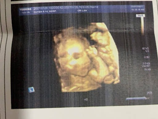 Nay em đi gặp gái yêu của em đây các bác ạ..con đc 21 tuần rồi trộm vía cưng lắm.. mỗi lần mẹ thai giáo là máy mẹ nhìu🥰con còn chào bs siêu âm cho con nữa nè..mẹ con lên 1 cân thôi..ăn bao nhiu đều vào con hết..nay 21 tuần mà con nặng 420gam rồi..bs khen con ngoan lắm nè 🥰mẹ con chúc các mom có 1 thai kỳ mạnh khoẻ nhé