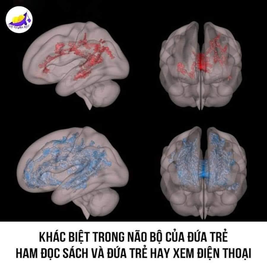 KHÁC BIỆT TRONG NÃO BỘ CỦA ĐỨA TRẺ ĐƯỢC CHƠI CÙNG BỐ MẸ NHIỀU VÀ ĐỨA TRẺ HAY XEM TI VI, ĐIỆN THOẠI

Nhiều Bố Mẹ hiện nay vì ᴄông việc bận rộn nên không chú ý nhiều đến “việc chơi” của trẻ, không ít phụ huynh đã thoải mái bật tivi, đưa cho con một chiếc Ipad hay điện thoại thông minh để con xem, tránh làm phiền cha mẹ làm việc.

Tuy nhiên, bạn lại không biết hành động này là một trong những nguyên nhân chính kìm hãm sự phát triển não bộ của trẻ nhỏ trong 5 năm đầu đời, đã được các nhà khoa học chứng minh qua hình ảnh chụp não bộ của trẻ dưới đây.

‼️2 hình ảnh não bộ bên trên (có các khu vực màu đỏ) là ảnh chụp bên trái và phía trước bộ não của một trẻ mẫu giáo thường xuyên được bố mẹ chơi cùng mỗi ngày.

‼️2 hình ảnh não bộ bên dưới (có các khu vực màu xanh da trời) là ảnh chụp bên trái và phía trước bộ não của một trẻ mẫu giáo thường xuyên xem tivi, điện thoại >2 tiếng mỗi ngày.

‼️Các khu vực màu xanh cho thấy sự kém phát triển và vô tổ chức của chất trắng, tức là đứa trẻ này sẽ gặp khó khăn trong việc học sau này.

‼️Các khu vực màu đỏ cho thấy sự gia tăng về chất trắng có tổ chức chứng tỏ đứa bé này có khả năng ngôn ngữ và khả năng đọc viết tốt, hỗ trợ rất nhiều cho việc học ở trường sau này. Sự gia tăng và có tổ chức của chất trắng là yếu tố quan trọng trong việc truyền thông tin giữa các phần khác nhau của não bộ, thúc đẩy các chức năng và khả năng học tập. Nếu không có một hệ thống truyền thông tin phát triển tốt, tốc độ xử lý của não sẽ chậm và gây khó khăn cho việc học tập.

Đây chính là những “bằng chứng thép” chứng minh cho những lợi ích tiềm năng của việc học, chơi cùng Bố Mẹ và những bất lợi tiềm tàng của việc xem tivi điện thoại thường xuyên đối với sự phát triển não bộ của con.

Bố Mẹ xin lưu ý, điều này vô cùng quan trọng với một đứa trẻ vì bộ não phát triển nhanh nhất trong 5 năm đầu đời. Những đứa trẻ có nhiều trải nghiệm kích thích bộ não sắp xếp tổ chức sẽ có lợi thế rất lớn khi đi học.

Và thực sự rất khó để đạt được sự sắp xếp này nếu đứa trẻ không có nhiều cơ hội trải nghiệm.
