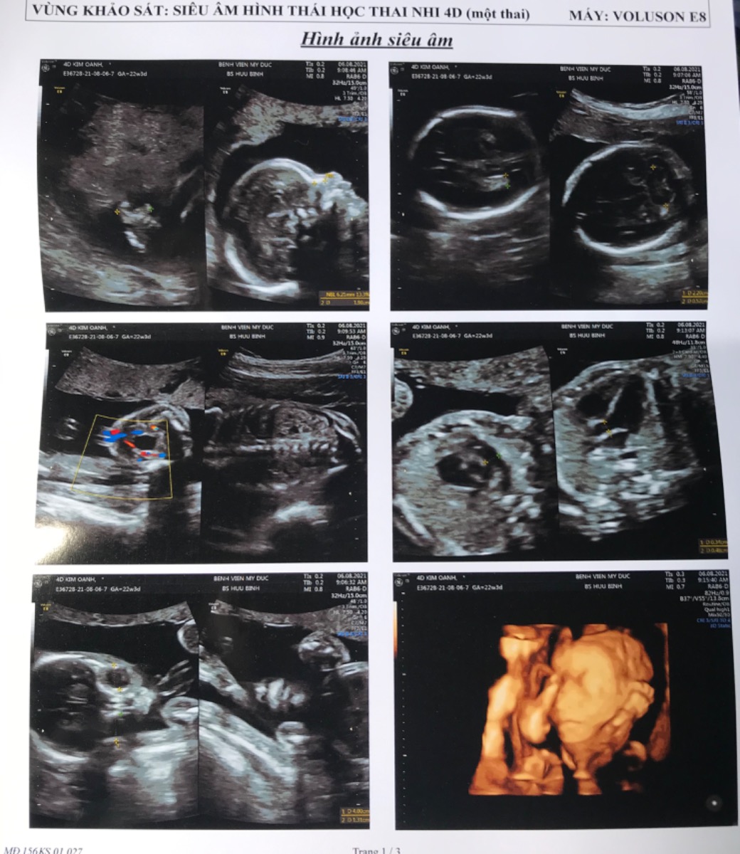 Các mon đi siêu âm 4D bác sĩ có cho biết giới tính bé k ạ? E hỏi mà bác sĩ k nói kêu về coi video sẽ biết mà thật e xem mãi vẫn k nhìn ra, hóng quá mà k biết các mon ơi, có mon nào nhìn ra bé nhà e là trai hay gái k ạ?