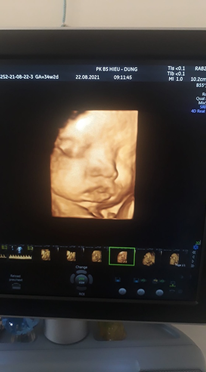 ☘Viết cho em bé của mẹ ❤

Mẹ chỉ định sinh đến anh con là kế hoạch luôn,nên anh con 7 tháng mẹ đã đặt vòng. Đến 1 hôm mẹ bảo đi thay vòng để lâu không tốt,là 5 năm sau.
1 ngày đẹp trời, ngực mẹ đau,mẹ bảo k lẽ bị u vú hay sao ?.
Đã mang bầu 3 lần nhưng vẫn như gà mờ.Mẹ mua que thử ,2 vạch đỏ chót,gọi cho cô bạn mua thêm cho que nữa, kết quả vẫn 2 vạch.
Mẹ từng nói vs ba con ,nếu k cẩn thận để có ,mẹ sẽ bỏ.Nhưng đến lúc có em,mẹ hối hận vì đã từng nói như thế.Người ta sẽ hào hứng vui vẻ khoe vs mọi người khi biết tin có thai,nhưng mẹ k dám,ngay bà ngoại mẹ cũng giấu.
Vì mẹ mới 28 tuổi,nhưng đã có 3 anh chị,thêm em là thứ 4.
Mọi chuyện sẽ chẳng có gì để nói cho đến lúc em đc 12w.Mẹ đang đi lễ trong nhà thờ, ọc 1 cái,linh cảm k lành mẹ ra nhà vệ sinh thì thấy máu tươi ở quần.Rồi cứ thế chảy ào ào xuống chân.Mẹ khóc,mẹ nhìn Đức Mẹ rồi xin,chỉ xin Đức Mẹ giữ em lại bên mẹ.
Trước giờ xem phim chỉ thấy cảnh chảy máu, k ngờ có ngày nó xảy ra với mẹ con mình.
Mẹ đi bệnh viện, máu chảy ướt yên xe của cô bạn mẹ,chảy dọc hành lang bệnh viện, mẹ đã nghĩ ,em bỏ mẹ đi rồi.
Vào đến phòng siêu âm, khoảnh khắc nghe đc nhịp tim của em,mẹ lại khóc.Em đã ở lại với mẹ.
3 ngày sau mẹ đc về ,cứ nghĩ mọi chuyện sẽ êm xuôi, 14w mẹ lại bị ra máu .Lần này mẹ đi thẳng bv tỉnh,ngày tiêm 2 mũi thuốc đau thấu vs 1 đứa nhát đau sợ tiêm như mẹ,nhưng vì em ,đau hơn mẹ cũng chịu được.
3 ngày sau mẹ được về,kèm theo thuốc uống, thuốc đặt.
Mẹ đi thăm em thường xuyên đến khi bs nói ổn mẹ mới cảm thấy nhẹ nhõm.
Cũng có khi vì lo lắng nên giờ 36w mẹ mới lên có 3kg,tv em bé của mẹ phát triển khỏe mạnh.Chỉ còn 2 tuần nữa mẹ con mình gặp nhau rồi.Mong em bé của mẹ ngoan ngoãn chờ ngày ra với mẹ.
Vài lời gửi tới các mẹ trong nhóm.Biết là trong quá trình mang thai,tâm lý ,sức khỏe và nhiều vấn đề khác nhưng cứ tin tưởng loời khuyên của các bs,tâm lý thật thoải mái, và mọi chuyện sẽ tốt đẹp thôi.
Chúc các mom có 1 thai kỳ khỏe mạnh, cán đích thành công .