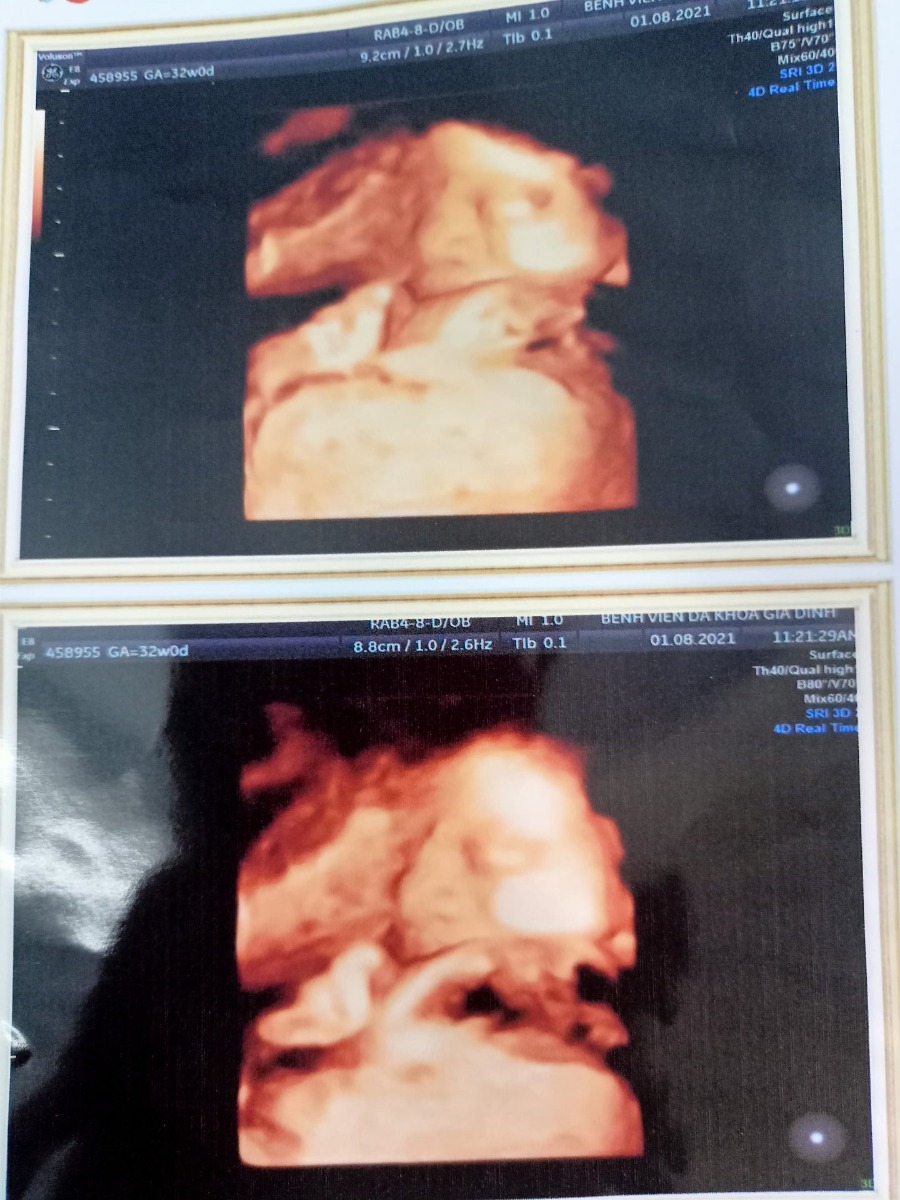 Gửi Ben chàng trai 37w của mẹ
Lúc mẹ viết những dòng này mẹ đang rất hạnh phúc chờ đón ngày con chào đời.
Em là chàng trai rất dũng cảm đến bên mẹ trong lúc mẹ bi quan chán nản.
- Ba và mẹ cưới nhau vào cuối năm 2018, sau đó ba mẹ kế hoạch để mẹ đi tiêm phòng trước bầu. Vào tháng 6/2019 sau khi đã tiêm phòng xong ba mẹ bắt đầu thả. Hai tháng sau mẹ thử que 2v, mẹ vỡ òa nhưng rồi niềm vui chẳng được bao lâu. Lúc 7w4d với niềm háo hức mong mỏi mẹ bước vào phòng siêu âm thì bs thông báo là anh/ chị con không có tim thai hội chẩn kết luận thai ngừng phát triển. Mẹ không tin điều đó. Ba và mẹ lại đi 2 3 Bv khác để mong là BV chẩn đoán nhầm có hi vọng nào đó không. Nhưng không tất cả các BV đều có cùng 1 kết luận. Ba đưa mẹ nhập viện để làm thủ tục lấy anh/ chị con ra. Ngày đó là ngày nắng mà mẹ khóc hơn mưa. 
-Sau đó ba mẹ uống thuốc bổ các kiểu, mẹ quyết tâm chuẩn bị kỹ trước khi có bầu lần tiếp. Tiếp sau sau 9 tháng mẹ lại thử que 2v lần thứ 2 lần này mẹ vừa mừng vừa lo. Mẹ thử que 2v xong bị ra máu, ba đi làm xa cậu chở mẹ đi cấp cứu ở Bv. BV báo là e bé có tim thai rồi 110l/p lúc đó thai 5w5d. Bác sỹ kêu ổn rồi nhưng tim thai hơi yếu hẹn 2w nữa đi kiểm tra lại. Mẹ được cậu chở về ăn nằm để dưỡng thai. 2w sau với niềm hạnh phúc anh chị con vẫn đang ổn trong bụng mẹ thì mẹ lại được bác sỹ thông báo là không tìm thấy tim thai nữa. Mẹ ngã gục nước mắt không biết sao không còn chảy được nữa. Lại 1 lần nữa mẹ phải nhập viện để đưa anh/ chị con ra. Mẹ còn nhớ ngày đó là ngày sinh nhật mẹ mà mẹ phải ngậm thuốc đẩy anh/ chị con ra. 1 ngày sinh nhật tràn đầy nước mắt.😢😢😢😢
- Ba mẹ dành tiền đi làm hết xét nghiệm tìm nguyên nhân nhưng chẳng có nguyên nhân nào cụ thể, ba mẹ theo bác sỹ và tiếp tục uống thuốc bổ trước bầu. Tháng hơn 5tr nhưng vì tìm con ba mẹ luôn rang hết mình. Sau khi uống thuốc được tháng thứ 3 mẹ bất ngờ trễ kinh, cảm giác nôn nao như bị say xe mẹ chỉ nghỉ là mẹ mệt vì bình thường ba mẹ phải canh trứng canh ngày các kiểu mới có đây ba mẹ chẳng canh me chi. Dì cùng công ty xúi mẹ mua que thử đi mẹ còn kêu" Tốn tiền thôi chớ dễ gì có". Và thật bất ngờ mẹ thử lên 2v.
- Mẹ theo phòng khám ở tận Hà Nội theo dạng từ xa. Chụp hình que 2v cho phòng khám. Bs biểu mẹ đi xét nghiệm beta Hcg cho chắc. Mẹ gọi người tới nhà lấy máu chờ đợi kết quả dài dằng dặc. Và rồi người ta thông báo rằng mẹ đã có thai.
Thế là hành trình dưỡng thai bắt đầu. Mẹ thử que lên 2v 2 ngày sau mẹ lại bị ra máu mẹ hoang mang không biết con có bỏ mẹ như anh/ chị con không. Mẹ nằm 1 chỗ, xin nghỉ làm, ăn ngủ và đặt thuốc dưỡng tiêm thuốc nội tiết với hi vọng giữ con lại bên ba mẹ. Hằng tuần mẹ đi siêu âm kiểm tra xem con có ổn không. 5w rồi 6w3d con chưa có tim thai, phôi nhỏ bác sỹ bảo tiên lượng dè dặt, mẹ không biết bấu víu vào đâu chỉ biết phó mặc cho trời. Rồi mẹ nghỉ con bỏ mẹ đi như anh/ chị con chắc mẹ cũng đi theo con hoặc giải thoát cho ba 😔😔😔😔
- Ngày đó là ngày 25 tết năm 2020 mẹ cầm tờ kết quả siêu âm không nói nên lời, về que nằm nhà nửa tháng để bà ngoại chăm. Ngày 10 tết âm lịch ba từ Quảng Nam ra nhà chở mẹ vô đi khám. Đêm trước ngày đi khám mẹ hồi hộp mất ngủ. Sáng hôm sau với sự ám ảnh của những lần trước. Mẹ leo lên bàn siêu âm, bác sỹ siêu âm 1 hồi mẹ cảm giác dài như cả thế kỷ, mẹ nín thở chờ đợi. Sau đó bác sỹ nói e bé có tim thai rồi nhịp tim đều, mẹ như sống lại. Bước xuống khỏi bàn siêu âm ngoài trời thì nắng mà mẹ thấy lưng mình ướt nhẹp mồ hôi. Bs cười cười bảo ổn rồi không sao đâu. Lúc đó mẹ mới tin đó là sự thật 🥰🥰🥰🥰🥰
- 3 tháng đầu mẹ hồi hộp từng ngày, mỗi lần đi khám là mỗi lần lo rất may con bình thường phát triển trong bụng mẹ. 16w bác sỹ bảo là 1 anh ku. Mọi người chúc mừng mẹ kêu đẻ con trai cho yên tâm. Mẹ chỉ mỉm cười, đối với mẹ việc con khỏe mạnh phát triển trong bụng mẹ quan trọng hơn hết thảy việc con là trai hay gái.
- Mẹ đi khám đều đặn 1w/lần rồi 2w/ lần mọi người ai cũng la sao đi siêu âm nhiều thế. Mẹ bỏ ngoài tai tất cả chỉ đi theo chỉ định của bs. Rất hạnh phúc vì lần nào con cũng phát triển khỏe mạnh.
-24w mẹ đi test tiểu đường thai kỳ chỉ số đường sau 2h bị cao bác sỹ kêu bị rối loạn về ăn theo chế độ tiết thực. 28w bác sỹ kêu uống đường test lại nhắm mắt nhắm mũi uống vẫn bị đường sau 2h cao. 32w mẹ test lần 3 vẫn y như vậy. Thiệt chưa bao giờ thấy ai uống nước đường nhiều như mẹ 🤣🤣🤣 Bs kêu nên đi gặp bác sỹ chuyên nội tiết để xem có cần phải tiêm thuốc insulin không. Bs tư vấn mẹ mua cái máy test đường tại nhà. Thế là đều như vắt chanh ngày me chích máu 3 lần để kiểm tra. Rất may chỉ số của me không tới mức phải tiêm thuốc chỉ tiếp tục theo dõi và ăn theo chế độ tiết thực.
Nay thành phố lockdown mẹ chẳng mua que test được chỉ biết hằng ngày theo dõi con đạp. Mà con lỳ quá cơ ngày thì sơ sơ sương sương tối thì đạp khí thế làm mẹ mất hết cả ngủ 😅😂Mẹ vẫn cố gắng mong con đủ ngày đủ tháng ra chơi với ba mẹ. Đến giờ mẹ vẫn chưa biết mặt con lúc thì lấy chân, tay che mặt, lúc thì nằm úp. lúc thì dây rốn che 😁. Thôi chờ ngày con chào đời mẹ nhìn mặt trực tiếp vậy.
Chúc tất cả các mom có 1 thai kỳ khỏe mạnh và đón thiên thần của mình
Yêu con Chàng trai tháng 9 của mẹ ❤ ❤