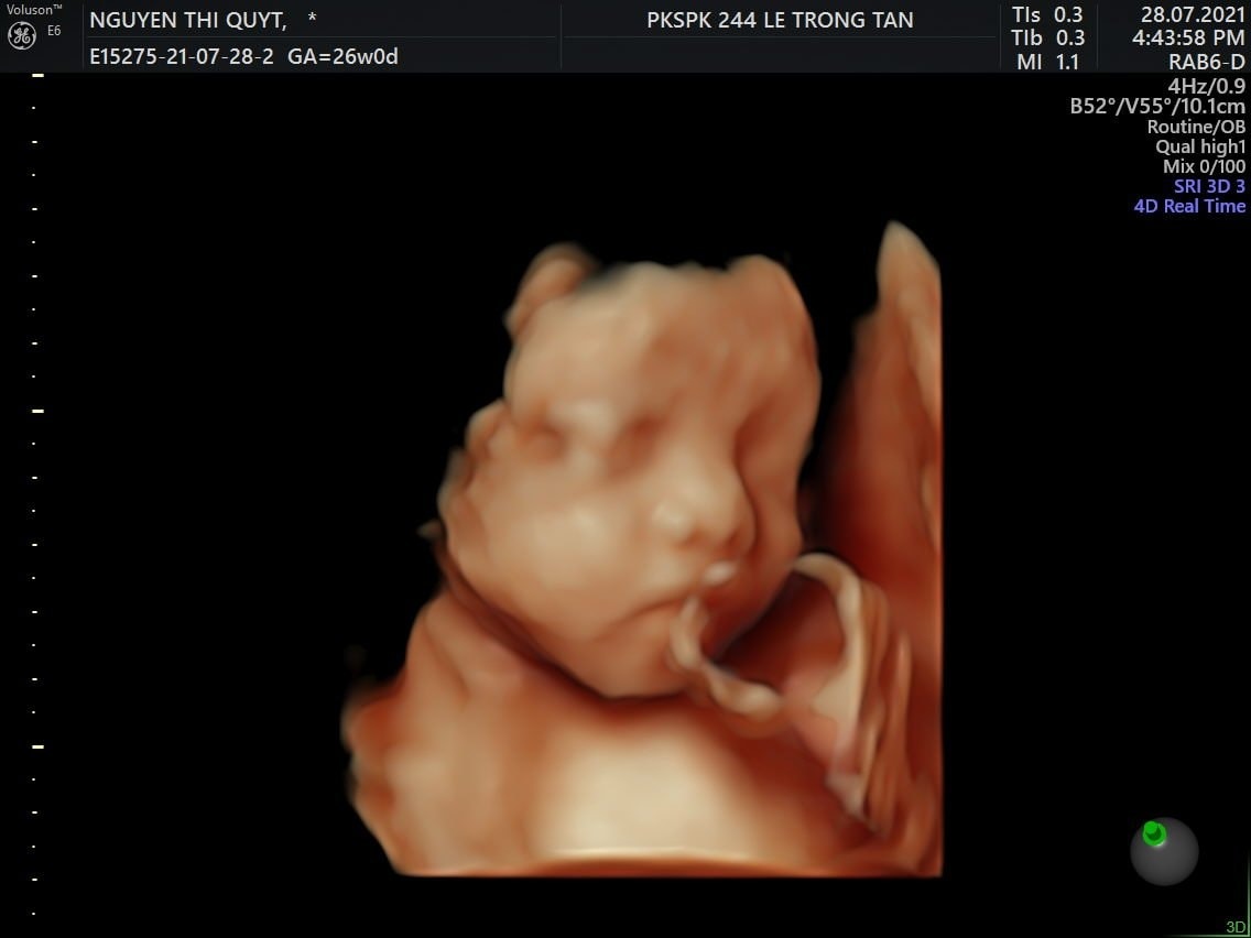 Không biết hành trình mang bầu của các mom như thế nào nhưng với mình từ lúc đi " xin vía bỏ bụng" đến lúc mang bầu phải ví như Đường Tăng đi lấy chân kinh thật lắm gian nan và thật lắm drama.
Đầu tiên phải kể đến hành trình "xin vía bỏ bụng". Đã mom nào rơi vào tình cảnh dở khóc dở cười như mình chưa? Trước khi lấy chồng mình thề là không bao giờ lấy chồng là con một hay con trưởng. Rồi thì khi lấy chồng xong phải cùng chồng tận hưởng cuộc sống hai đứa đã, mình và chồng đều kế hoạch trong việc có con. Nhưng đúng là người tính không bằng trời tính. Chồng mình là con trưởng, lại là cháu "đít nhôm" của cả họ. Lỡ lần 1! Tự nhủ với lòng là " Ok. I'm fine." Rồi lỡ lần 1 chắc chắn sẽ có lỡ lần 2. Và quả đúng vậy. Vừa cưới được tháng mốt, đầu mình lúc nào cũng ong ong cái điệp khúc " đã có gì chưa, không được dùng bcs hay thuốc tránh thai đâu nhá" rồi là "không được kế hoạch nghe chưa, thằng A, con B nó bằng tuổi hai đứa mà đã 3 đứa rồi đó"... Mình nghe xong cũng chỉ biết vâng vâng, dạ dạ. Nghe nhiều thành ám ảnh, đến ngủ mình cũng nằm mơ thấy mng nói. Rồi chuyện gì đến cũng đến. Hai tháng sau ngày cưới, mình vẫn "chưa có gì". Các bô lão vì mong có cháu nối dõi, cháu bồng cháu bế nên lo sốt vó đi lạy tứ phương để mình có bầu, rồi không quên cắt cho mình hàng gánh thuốc bắc để uống. Cái vụ uống thuốc bắc đó bây giờ nghĩ lại mình vẫn thấy rùng mình. Mình cảm giác từ tóc đến chân chỗ nào cũng ám mùi thuốc bắc. Mình và chồng tự nhiên cũng vì chuyện con cái mà stress đành gác lại cái gọi là kế hoạch để vừa lòng các cụ 2 bên. Mình bắt đầu tìm các hội nhóm mẹ bầu để học hỏi kinh nghiệm. Cứ thấy mom nào up ảnh 2 vạch là mình lại vào "xin vía bỏ bụng" rồi mình cũng mua thuốc bổ sung cho cả vợ và chồng. Không biết có phải do chăm xin vía nên ơn giời sau 5 tháng cuối cùng mình cũng có bầu.
Rồi từ ngày có Con, mình càng thấu hiểu được sự vất vả việc làm cha làm mẹ.Là mẹ ai cũng muốn dành cho con những điều tốt nhất. Mình cũng vậy. Ốm nghén nhưng vì nghĩ sợ con thiếu chất nên cố nhắm mắt nhắm mũi ăn. Nhưng thức ăn chưa trôi xuống cổ đã nôn hết ra. Trước mình đúng thuộc túyp người hít không khí cũng béo, ăn uống thì như ngải heo nhập vậy mà ốm nghén mình đã sụt ngót nghét chục cân. Ròng rã hơn 5 tháng, những cơn ốm nghén hành hạ đến nỗi mình đã khóc không biết bao nhiêu lần. Mình nôn nhiều đến nỗi ra cả máu, rồi nhiều khi nôn không kịp nôn ra bằng cả mũi. Rồi đỉnh điểm là việc mình ngất trong nhà vệ sinh. Lúc đó mình chỉ ý thức được một việc duy nhất là không được đập bụng xuống sàn nhà vì lo sợ con chẳng may làm sao. Mình không đếm được mình đã truyền bao nhiêu chai nước từ lúc bầu đến giờ. May mắn là con vẫn khoẻ mạnh. Và bây giờ mình đã 32w rồi.Đúng là chỉ cần con khoẻ mạnh, đủ ngày đủ tháng đã là niềm vui cũng là niềm an ủi, động viên lớn nhất cho bố mẹ rồi đúng không các mom. Cảm ơn các mom đã đọc những lời lan man của mình. Và chúc tất cả các mom sẽ có một thai kì khoẻ mạnh để đón những thiên thần bé nhỏ!
Ps: Coca lúc 26w ❤️ từ lúc mang bầu đến giờ có mỗi lần nàng cho xem mặt đấy các mom ạ. Không lấy tay che thì cũng úp mặt vào bụng mẹ😓