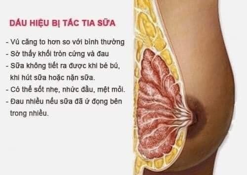 ⚠️⚠️Tắc tia sữa – Nguyên nhân, triệu chứng và cách chữa trị⚠️⚠️

Tác giả: Trần Lê Phương Uyên
Tham vấn y khoa: BS. Nguyễn Thường Hanh

✅Không ít mẹ nuôi con bằng sữa mẹ bị tắc tia sữa nhưng không biết cách xử lý kịp thời khiến bầu vú bị áp xe, viêm vú gây ảnh hưởng đến sức khỏe và sinh hoạt.

✅Nguyên nhân gây tắc tia sữa

1. Tắc tia sữa là gì?

Tắc tia sữa là tình trạng sữa mẹ bị giữ lại bên trong các ống dẫn sữa ở bầu ngực. Hiện tượng này có thể khiến việc cho con bú cũng như hút sữa để tích trữ gặp nhiều khó khăn, đau đớn. Nếu không được giải quyết nhanh chóng, tắc tia sữa có thể dẫn đến các vấn đề lớn hơn, ví dụ như viêm vú hoặc dừng hẳn việc ra sữa, từ đó gây ra nhiễm trùng.

2. Nguyên nhân gây tắc tia sữa là gì?

👉Có nhiều nguyên nhân gây ra tình trạng tắc tia sữa ở phụ nữ cho con bú, chẳng hạn như:

👉Mới sinh con: Sau khi sinh, một số người gặp phải tình trạng tắc tia sữa. Sữa đã có nhiều trong bầu ngực nhưng vẫn không thể chảy ra ngoài cho bé bú được. Việc ứ đọng sữa dẫn đến vú căng cứng và có thể khiến bạn bị sốt nhẹ.

👉Sữa mẹ dư thừa: Hầu hết trong các trường hợp, nguyên nhân gây tắc tia sữa là do sữa mẹ còn thừa ở trong bầu ngực do em bé không bú hết hoặc bạn không hút phần sữa thừa sau khi bé đã bú no, dẫn đến sữa còn đọng lại, gây ra tắc nghẽn.

👉Ngực chịu áp lực: Việc bạn mặc một chiếc áo ngực quá chật, áo bó hoặc mang địu địu bé trước ngực đôi khi cũng khiến các tia sữa bị tắc. Ngoài ra, việc nằm sấp khi ngủ và tập luyện thể thao cũng gây ra tình trạng tương tự.
Ít hút sữa ra ngoài: Nếu ít hút sữa hoặc hút không hết sữa, bạn dễ gặp phải tình trạng tắc tia sữa. Lực hút của máy yếu không thể hút hết sữa ra ngoài cũng có thể là nguyên nhân khiến bạn bị tắc tia sữa.

👉Con ngậm vú mẹ không đúng: Khi bé ngậm vú mẹ không đúng cách, bé sẽ không thể bú đủ lượng sữa mẹ sản xuất ra. Do đó, sữa còn tồn đọng lại trong bầu ngực là nguyên nhân dẫn đến tắc tia sữa.

👉Mẹ không cho bú thường xuyên: Do một nguyên nhân nào đó, mà bạn không cho bé bú thường xuyên hoặc không hút sữa ra hết trong khoảng 5 giờ đến 1 ngày. Điều này cũng có thể dẫn đến tình trạng bị tắc tia sữa.

👉Stress: Tâm trạng có thể ảnh hưởng đến các hoạt động thường ngày của cơ thể. Việc sản xuất sữa cũng không nằm ngoài điều đó. Sự căng thẳng sẽ làm chậm quá trình sản sinh hormone oxytocin¹, giúp vú bạn giải phóng sữa. Vì vậy, hãy để bản thân được thư giãn. Nếu con đang say giấc, bạn cũng nên chợp mắt một chút. Khi đã quá mệt mỏi, hãy nhờ người thân trông bé để bạn có thể ra ngoài hít thở không khí trong lành và lấy lại tinh thần.
Dấu hiệu tắc tia sữa điển hình

❌Dấu hiệu tắc tia sữa

Dù bạn đang ở giai đoạn đầu cho con bú sữa mẹ hoặc đã cho con bú một thời gian, tình trạng tia sữa bị tắc nghẽn có thể xảy ra bất cứ lúc nào. Bạn có thể chú ý đến một số khu vực của vú có hiện tượng cứng và khó chịu. Ngoài ra, tắc tia sữa còn có triệu chứng như:

👉Đau, tức ngực nhẹ
👉Các nốt sần nhỏ nổi trên ngực
👉Ngực sưng đỏ
👉Một số khu vực ở ngực có cảm giác ấm nóng bất thường khi chạm vào.

❌Cách chữa tắc tia sữa tại nhà

✅Khi bị tắc tia sữa, việc đầu tiên mà đa số các mẹ thường làm là tạm dừng cho con bú để ngăn chặn cơn đau. Tuy nhiên, điều này lại sai hoàn toàn. Cách chữa tắc tia sữa hiệu quả là hãy duy trì việc cho bé bú sữa mẹ. Cho trẻ bú mẹ thường xuyên sẽ giúp tình trạng này giảm đi rất nhiều hoặc bạn cũng có thể sử dụng máy hút sữa nhằm thông tia sữa bị tắc.

✅Bạn đang cho con bú nhưng bắt đầu thấy căng tức, không thoải mái ở vùng ngực, hãy nhẹ nhàng massage bầu vú trong khi con đang bú hoặc đang hút sữa bằng máy. Ngoài ra, các chuyên gia cũng khuyến khích bạn nên nghỉ ngơi thật nhiều, bổ sung thêm nước để sữa tiết ra đều đặn hơn.

✅Bên cạnh đó, bạn cũng có thể áp dụng một số biện pháp sau đây:

✅Cho bé bú bên ngực bị đau trước: Nếu bầu vú không quá đau đớn, bạn nên cho con bú ở ngực bị tắc tia sữa trước bởi lúc này con sẽ bú bằng lực mạnh nhất để hút sữa mẹ, nhờ đó giúp khai thông các tia sữa bị tắc.

✅Chườm ấm quanh bầu ngực có thể giúp sữa chảy đều đặn hơn.

✅Thay đổi tư thế cho con bú: Nếu thường xuyên bế con khi cho bé bú, bạn có thể chuyển sang tư thế ôm banh hoặc nằm xuống. Điều này sẽ giúp sữa trong các tia được hút hết ra ngoài.

✅Xoa bóp: Các chuyên gia khuyên bạn nên xoa bóp vùng ngực đau thường xuyên và đều đặn. Hãy bắt đầu từ bầu vú hướng dần vào trong núm vú. Áp dụng biện pháp chườm ấm trước khi cho con bú có thể giúp khai thông các tia sữa, hỗ trợ giảm đau và sưng.

✅Chế độ dinh dưỡng: Hãy uống thật nhiều nước, đồng thời bổ sung những loại thức ăn có khả năng tăng cường sức đề kháng.

✅Nghỉ ngơi: Tuy bạn khó có thể nghỉ ngơi khi phải chăm sóc con cả ngày nhưng điều này lại rất quan trọng. Khi bé ngủ, bạn hãy cố gắng chợp mắt cùng con. Ngoài ra, để tiết kiệm sức lực, bạn có thể để những đồ đạc thường xuyên sử dụng ở gần mình, chẳng hạn như tã lót, đồ chơi, bình sữa… Nếu có thể hãy nhờ người thân trông con hộ để được nghỉ ngơi.

❌Cách ngăn ngừa tình trạng tắc tia sữa an toàn

👉Để ngăn ngừa tình trạng tia sữa bị tắc nghẽn, bạn cần cho con bí thường xuyên ,kiệt sữa, sau mỗi cữ bú làm trống tuyến sữa để ko gây tình trạng tắc sữa nhé.