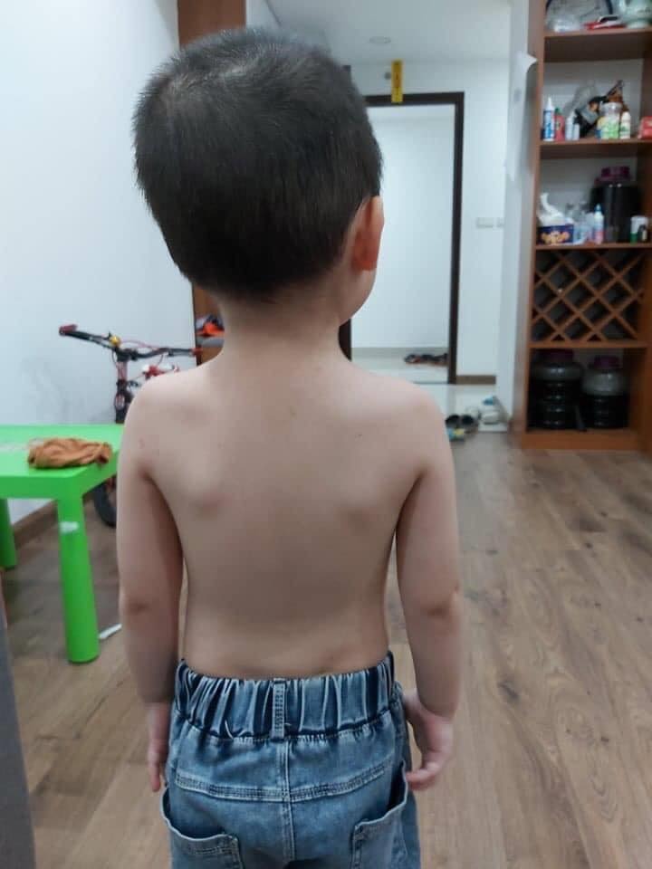 Hãy dành ra 5 phút mỗi ngày để ngắm con một cách cẩn thận! 💗💗💗🧐🧐🧐

Dưới đây là hình ảnh của hai bé 4 tuổi, bé trai được cha mẹ tình cờ phát hiện khi thấy con có thói quen ngồi nhìn lệch hướng sang phải, bé gái được phát hiện khi qua nhà Bs chơi thấy con bị lệch vai và nhìn lệch phải. Cả hai bạn được Bs chỉ định chụp Xq kiểm tra cột sống cổ thì có kết quả.

- Cong vẹo cs cổ độ I
👉 Nguyên nhân:
- Do thói quen ngồi, sinh hoạt, xem điện thoại, học bài ko đúng tư thế.
- Thiếu Canxi.
👉 Biến chứng:
- Cong vẹo độ II, III, cong vẹo cột sống ngực, cột sống thắt lưng, ảnh hưởng đến chức năng tim phổi...
👉 Điều trị:
- Vật lý trị liệu, phục hồi chức năng sớm nhất có thể.
- Chỉnh sửa tư thế ngồi ăn, học, xem tivi, điện thoại.

🧐 Cách kiểm tra: cho con mặc quần ngắn, cởi áo, tư thế hai chân đứng hình chữ V hai tay buông lỏng, mắt nhìn thẳng.
Bố mẹ ngồi phía trước quan sát các điểm để so sánh.
- Hai vai có bằng nhau không?
- Hai tai có bằng nhau so với hai vai không?
- Mặt có nhìn thẳng hay lệch trái hoặc phải
- Nhân trung- cằm và xương ức có thẳng hàng không?
Ngồi phía sau con quan sát
- Cột sống lưng và cổ có thẳng hay không?
- Hai xương bả vai có bằng nhau không?
Ngồi sang trái hoặc phải quan sát:
- Tai và vai có nằm trên một đường thẳng hay không?

Nếu có các dấu hiệu bất thường thì cha mẹ nên cho con đi khám chuyên khoa sớm nhất có thể.

Note: Mọi người hãy dành chút thời gian để ngắm con mình một cách cẩn thận để có thể phát hiện những dấu hiệu bất thường có thể mắt thường nhìn thấy như, nhìn lệch, ngồi vẹo, vai lệch, cổ áo không cân.
Giai đoạn ban đầu các bạn nhỏ thường không có biểu hiện gì về cảm giác đau mỏi do vậy việc cha mẹ chú ý và phát hiện các triệu chứng là rất quan trọng, điều này quyết định đến việc mức độ cong vẹo cũng như thời gian điều trị nhanh hay chậm.