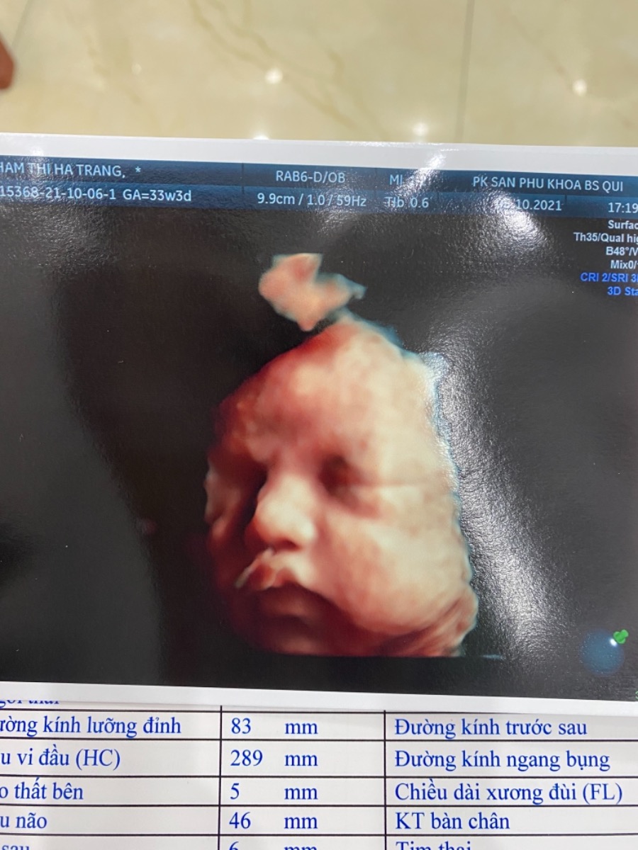 Có mom nào xin vía mũi cao của trâu cái nhà em không ạ? Lần nào siêu âm bác sĩ cũng khen. 
Em 33w3d siêu âm con được 2kg2. Liệu đến khi sinh con có được hơn 3kg không ạ???