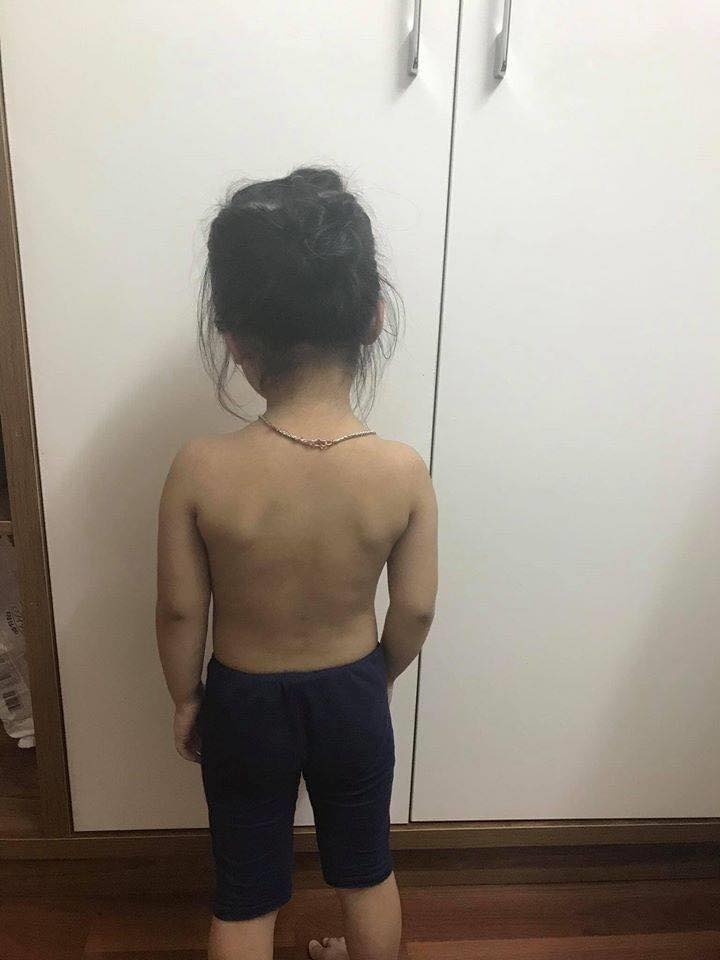 Hãy dành ra 5 phút mỗi ngày để ngắm con một cách cẩn thận! 💗💗💗🧐🧐🧐

Dưới đây là hình ảnh của hai bé 4 tuổi, bé trai được cha mẹ tình cờ phát hiện khi thấy con có thói quen ngồi nhìn lệch hướng sang phải, bé gái được phát hiện khi qua nhà Bs chơi thấy con bị lệch vai và nhìn lệch phải. Cả hai bạn được Bs chỉ định chụp Xq kiểm tra cột sống cổ thì có kết quả.

- Cong vẹo cs cổ độ I
👉 Nguyên nhân:
- Do thói quen ngồi, sinh hoạt, xem điện thoại, học bài ko đúng tư thế.
- Thiếu Canxi.
👉 Biến chứng:
- Cong vẹo độ II, III, cong vẹo cột sống ngực, cột sống thắt lưng, ảnh hưởng đến chức năng tim phổi...
👉 Điều trị:
- Vật lý trị liệu, phục hồi chức năng sớm nhất có thể.
- Chỉnh sửa tư thế ngồi ăn, học, xem tivi, điện thoại.

🧐 Cách kiểm tra: cho con mặc quần ngắn, cởi áo, tư thế hai chân đứng hình chữ V hai tay buông lỏng, mắt nhìn thẳng.
Bố mẹ ngồi phía trước quan sát các điểm để so sánh.
- Hai vai có bằng nhau không?
- Hai tai có bằng nhau so với hai vai không?
- Mặt có nhìn thẳng hay lệch trái hoặc phải
- Nhân trung- cằm và xương ức có thẳng hàng không?
Ngồi phía sau con quan sát
- Cột sống lưng và cổ có thẳng hay không?
- Hai xương bả vai có bằng nhau không?
Ngồi sang trái hoặc phải quan sát:
- Tai và vai có nằm trên một đường thẳng hay không?

Nếu có các dấu hiệu bất thường thì cha mẹ nên cho con đi khám chuyên khoa sớm nhất có thể.

Note: Mọi người hãy dành chút thời gian để ngắm con mình một cách cẩn thận để có thể phát hiện những dấu hiệu bất thường có thể mắt thường nhìn thấy như, nhìn lệch, ngồi vẹo, vai lệch, cổ áo không cân.
Giai đoạn ban đầu các bạn nhỏ thường không có biểu hiện gì về cảm giác đau mỏi do vậy việc cha mẹ chú ý và phát hiện các triệu chứng là rất quan trọng, điều này quyết định đến việc mức độ cong vẹo cũng như thời gian điều trị nhanh hay chậm.