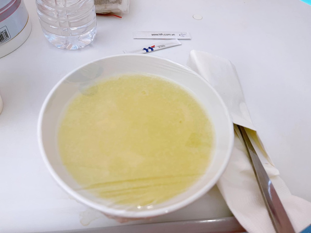 REVIEW ĐI ĐẺ MÙA DỊCH MỘT MÌNH 😍

Vì là mùa dịch nên hai mẹ con cháu phải ở cùng nhau hai mình 4 ngày liền 😆, nên mẹ cháu khá rảnh viết vài dòng review cho vui nhé các bác 🥰

Lần 1 mẹ cháu đẻ vinmec, Lần 2 này mẹ cháu đăng kí gói sinh mổ ở Việt Pháp để gửi gắm thân mình mùa dịch 🥰 , bởi tiện gần nhà , chi phi hợp lý hơn vinmec (so sánh hiện tại) và viện có chăm sóc mẹ và bé 24/24 nên mẹ thích chỉ cần vác bụng bầu đi đẻ thôi 😆 

✅ Mẹ Moon là được xếp ca mổ đầu tiên trong ngày 18/10. Ngày hôm trước em qua viện làm test nhanh 350k nên sáng 6h30 vào viện luôn, được cô y tá dẫn chọn phòng và tắm rửa sát khuẩn sạch sẽ, nằm nối truyền nước 1 lúc khoảng 8h là được đẩy phòng mổ r chu đáo. Phòng mổ của viện đẹp và sạch sẽ. Các cô y tá hỏi thăm mẹ liên tục và đặc biệt khi nằm sinh được luồn ống sưởi vào 2 bên tay ấm cực phê ( điểm này vinmec k có) 😍

✅ Mẹ Moon được bác sỹ Thu - Trưởng khoa sản mổ nên yên tâm, dù có thuốc tê nhưng mọi thao tác mẹ đều cảm nhận rõ ràng và rất nhanh. 8h56 bác đặt dao mổ bắt đầu thì 8h58 bé Moon “ oe oe “ 🥰
Các cô y tá nhanh chóng bế con cho mẹ nhìn ngắm thơm má, hai mẹ con khóc sướt mướt, cả phòng ai cũng khen tv bé xinh quá 😍 mẹ sướng nổ mũi luôn. Ê kíp mổ và gây tê ca của em rất ân cần chu đáo, điểm 10 ạ 👍🏻 
Sau đấy mẹ cháu đc đưa đến phòng hậu phẫu để theo dõi và vì mẹ đi sinh 1 mình nên các cô hỗ trợ bé Moon cũng được đưa đến để da kề da vs mẹ luôn. Nằm khoảng 2 tiếng hơn thì mẹ cùng con xuống ph nghỉ ngơi tiếp . 

✅ Phòng ở thì màu hồng cute và cực kì sạch sẽ. Mùa dịch nên các mẹ dc chọn phòng và được ở phòng riêng không mất thêm phí nếu ở 1 mình, Hàng ngày đều đc lau dọn cẩn thận liên tục. Đồ dùng cá nhân cho mẹ và bé cũng đc chuẩn bị vô cùng đầy đủ, váy mẹ màu hồng lên dáng cực yêu nữa (ảnh minh hoạ) 😆 

✅ Ở VP sau sinh 3 tiếng dc uống nc, 6 tiếng dc ăn mà chưa cần đánh hơi, ôi ăn bát cháo lúc đói sướng vô cùng ạ 😆  Buổi tối tầm 9h các cô đã hướng dẫn cho mẹ đứng lên đi lại, hôm sau là đã tắm rửa gội đầu thơm tho cả hai mẹ con đc r ^^ (viện có cả dịch vụ các cô tắm cho mẹ nhé, nhưng mẹ chỉ nhờ hỗ trợ ngày đầu hôm sau tự túc 🤣) Cần gì cứ bấm nút là các cô tới liền nên dù đi sinh một mình cũng thấy k vấn đề 😆

✅ Đồ ăn ngon lắm ạ, ngày nào mẹ Moon cũng order đủ 5 bữa, chưa kể gọi thêm món :”> ngày nào cũng canh giờ ăn đến rồi để ngồi chén sạch hihi

Đến hiện tại thì mẹ cháu r hài lòng và hai mẹ con cháu tiếp tục tận hưởng 3 ngày nữa đây ạ 🥰 chúc các mẹ đi sinh mùa dịch an toàn và vui vẻ nha. Yêu thương nhiềuuu ạ hihi 😘😘