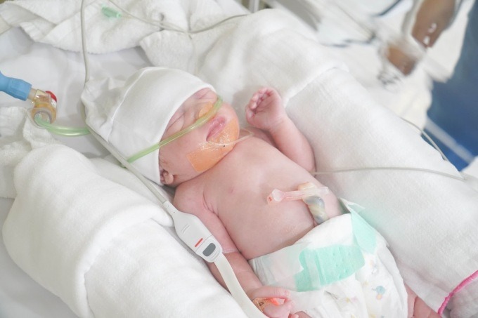 Ký tích: giữ thành công thai 18 tuần bị vỡ tử cung, xuất huyết ồ ạt tới hơn 2,5l máu trong ổ bụng, khối thai và nhau thai đã bị đẩy một phần ra khỏi tử cung & Hành trình 100 ngày cam go chăm sóc đồng hành thai phụ đến ngày mẹ tròn con vuông

Tại Việt Nam và thế giới, trong trường hợp thai phụ vỡ tử cung, các bác sĩ thường chọn cứu mẹ, khâu phục hồi tử cung hoặc cắt bỏ tử cung, nhưng như vậy sản phụ có thể vĩnh viễn mất cơ hội sinh nở sau này

Nhưng với trường hợp chị Nguyễn Thị Lành (29 tuổi, Hà Nội) lại quá éo le khi đã trải qua 4 lần phẫu thuật: bóc nhân xơ và hai lần xử lý thai ngoài tử cung, hai lần làm thụ tinh trong ống nghiệm IVF nhưng chưa từng một lần làm mẹ. Trước khao khát có con mãnh liệt của chị, Ths.BS Cao cấp Đinh Thị Hiền Lê , chuyên gia hàng đầu về y học bào thai và cấp cứu sản khoa của BVĐK Tâm Anh cùng ekip đã không thể quyết định cắt tử cung cứu mẹ như thông thường, mà chấp nhận mạo hiểm khi cứu cả mẹ lẫn con nhờ kỹ thuật cao cấp hàng đầu y học bào thai chưa từng được áp dụng ở Việt Nam. 

Với tâm lý còn nước còn tát, cố gắng, cứu cả mẹ và con bằng mọi giá. Kỳ tích đã đến... sau nhiều giờ phẫu thuật căng thẳng, thai nhi 18 tuần chỉ nặng 200 gram cùng nhau đã được đưa vào tử cung mà không làm ảnh hưởng đến bánh nhau còn lại, thai phụ vượt qua nguy kịch, không những giữ được tử cung mà còn giữ được sự sống của thai nhi.

Vượt qua thêm 100 ngày giữ thai với nhiều nguy cơ vỡ tử cung lần 2, gặp biến chứng thiểu ối, rỉ ối, gia tăng nguy cơ sinh non, đến tuần 33 bé gái con chị Lành đã chào đời khỏe mạnh, nặng 1,9kg.

Sau nhiều năm mong tìm, nhiều lần ở ngưỡng mất con giờ đây chị đã có được hạnh phúc làm mẹ, giấc mơ bao năm nay đã thành sự thật.