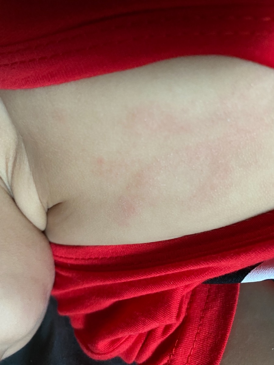 Các mom nhìn giúp e da bé vầy có phải bị viêm da dị ứng ko ạ