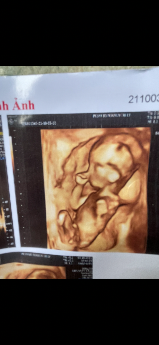 Mom nhìn dùm mình phải con trai rõ kg mình siêu âm lúc 15 w bs bảo trai nay 20 tuần lai kg cho thấy hoang mang quá