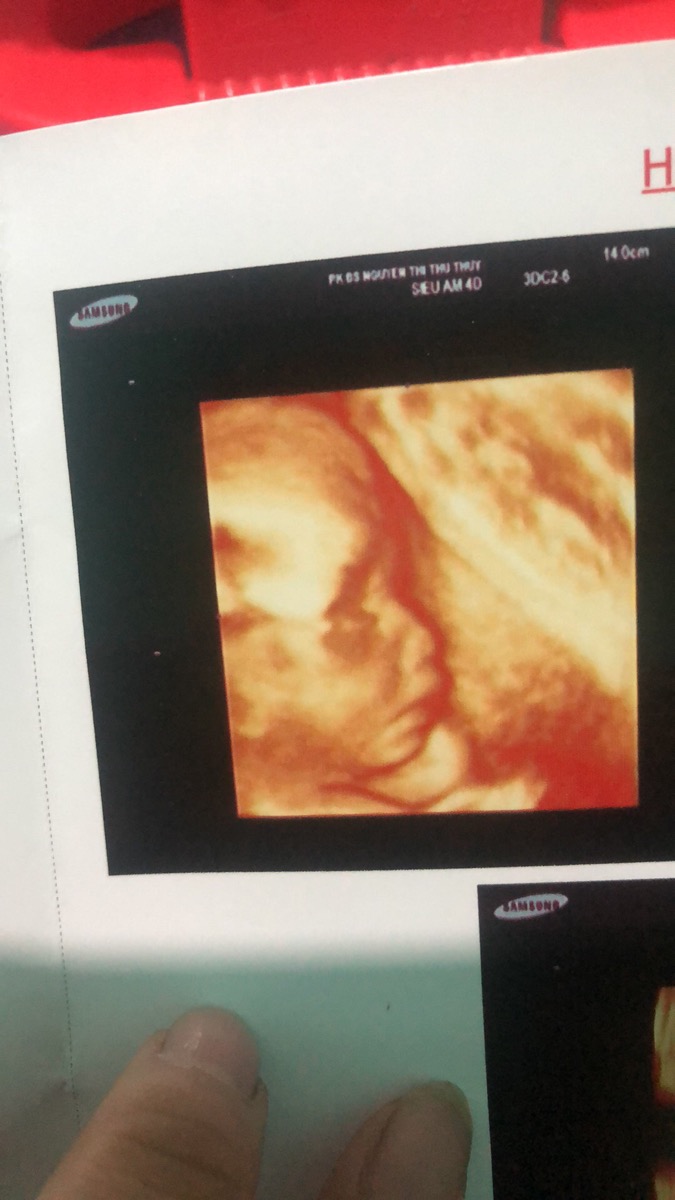 Bé su kem nhà em nay đc 23 tuần 4 ngày rồi 
Cân nặng 729 gram 🥰 yêu lắm