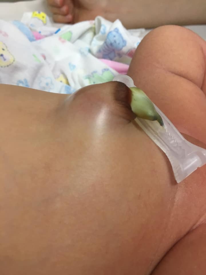🍼THOÁT VỊ RỐN Ở TRẺ SƠ SINH🍼

 🤗🤗Thoát vị rốn ở trẻ sơ sinh có thể tự khỏi được. Những trường hợp ruột của trẻ bị lồng vào gây #hoại_tử_ruột thì rất nguy hiểm, cần cho trẻ đến bệnh viện để kiểm tra và điều trị kịp thời.

👉👉Bệnh thoát vị rốn ở trẻ sơ sinh là gì?

Thoát vị rốn ở trẻ sơ sinh là tình trạng một phần nội tạng lồi ra khỏi vị trí vốn có của nó trong cơ thể. Phần nội tạng lồi ra tạo thành một khối lồi tại vùng rốn của trẻ.

🌟🌟Dây rốn là cầu nối đưa chất dinh dưỡng từ mẹ sang bào thai để nuôi dưỡng bé khi còn trong bụng mẹ. 

🌟🌟Dây rốn nối với thai nhi bằng một lỗ nhỏ trong cơ thành bụng. Khi em bé được sinh ra, #dây_rốn sẽ được cắt bỏ. Khoảng 7 - 10 ngày sau, cuống rốn sẽ teo dần, rụng đi, vết thương khô lại và tự lành, tạo thành rốn của trẻ. 

🌟🌟Lỗ ở thành bụng phần dây rốn đi qua dần dần tự đóng lại. Trẻ bị thoát vị rốn là trẻ có cơ bụng không thể tự đóng lại.

🇨🇭🇨🇭Thoát vị rốn ở trẻ sơ sinh thường gặp ở trẻ sinh non, sinh nhẹ cân. Tỷ lệ bé gái mắc thoát vị rốn nhiều hơn bé trai.

💝💝Cách phát hiện bệnh thoát vị rốn ở trẻ sơ sinh

🍀Khối #thoát_vị_rốn lồi lên tại vị trí lỗ rốn của trẻ. Cha mẹ có thể phát hiện bệnh bằng cách quan sát hoặc khi ấn nhẹ vào vùng rốn cảm thấy có một khối lồi lên. 

🍀Khối thoát vị sẽ to lên, có thể nhìn rõ hơn khi bé ưỡn người, ho, khóc hoặc khi bé ngồi dậy. Thoát vị rốn ở trẻ sơ sinh không gây đau nên không khiến cho bé khó chịu.

🇨🇭🇨🇭🇨🇭Bệnh thoát vị rốn ở trẻ sơ sinh có nguy hiểm không?

💧Bệnh thoát vị rốn ở trẻ sơ sinh không đáng lo ngại vì thông thường bệnh có thể tự khỏi, cơ thể bé sẽ dần thích nghi và trở về trạng thái bình thường.

👉👉Bệnh thoát vị rốn ở trẻ sơ sinh chỉ nguy hiểm nếu một phần của ruột lồng vào trong khối thoát vị và bị nghẹt không nhụ động ra ngoài được, máu không được lưu thông, lâu ngày khiến bé bị hoại tử ruột, thậm chí nhiễm trùng ổ bụng. 

👉👉Biểu hiện của tình trạng này là trẻ #đau_bụng, #quấy_khóc, #nôn_mửa. Khi đó, cha mẹ cần đưa trẻ đến bệnh viện cấp cứu ngay.

💝❤️💝Chữa thoát vị rốn ở trẻ sơ sinh như thế nào?

👉Trong trường hợp thoát vị rốn có thể tự lành, cha mẹ không cần làm gì, không nên có tác động gì đến rốn của trẻ.

👉Một vài trường hợp thoát vị rốn khôn gây đau đớn nhưng sau 3 - 4 năm vẫn chưa tự mất đi có thể đến bệnh viện để kiểm tra, các bác sĩ sẽ đẩy khối thoát vị vào ổ bụng một cách dễ dàng.

🇨🇭🇨🇭🇨🇭Với những khối thoát vị lớn và gây đau đớn cho trẻ, khối thoát vị bị nghẹt ruột, khối thoát vị có vùng da bên ngoài sưng nề và đỏ... thì phải can thiệp bằng việc phẫu thuật. Nên đưa trẻ đến bệnh viện càng sớm càng tốt để được thăm khám và điều trị kịp thời.