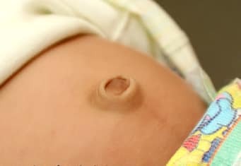 🍼THOÁT VỊ RỐN Ở TRẺ SƠ SINH🍼

 🤗🤗Thoát vị rốn ở trẻ sơ sinh có thể tự khỏi được. Những trường hợp ruột của trẻ bị lồng vào gây #hoại_tử_ruột thì rất nguy hiểm, cần cho trẻ đến bệnh viện để kiểm tra và điều trị kịp thời.

👉👉Bệnh thoát vị rốn ở trẻ sơ sinh là gì?

Thoát vị rốn ở trẻ sơ sinh là tình trạng một phần nội tạng lồi ra khỏi vị trí vốn có của nó trong cơ thể. Phần nội tạng lồi ra tạo thành một khối lồi tại vùng rốn của trẻ.

🌟🌟Dây rốn là cầu nối đưa chất dinh dưỡng từ mẹ sang bào thai để nuôi dưỡng bé khi còn trong bụng mẹ. 

🌟🌟Dây rốn nối với thai nhi bằng một lỗ nhỏ trong cơ thành bụng. Khi em bé được sinh ra, #dây_rốn sẽ được cắt bỏ. Khoảng 7 - 10 ngày sau, cuống rốn sẽ teo dần, rụng đi, vết thương khô lại và tự lành, tạo thành rốn của trẻ. 

🌟🌟Lỗ ở thành bụng phần dây rốn đi qua dần dần tự đóng lại. Trẻ bị thoát vị rốn là trẻ có cơ bụng không thể tự đóng lại.

🇨🇭🇨🇭Thoát vị rốn ở trẻ sơ sinh thường gặp ở trẻ sinh non, sinh nhẹ cân. Tỷ lệ bé gái mắc thoát vị rốn nhiều hơn bé trai.

💝💝Cách phát hiện bệnh thoát vị rốn ở trẻ sơ sinh

🍀Khối #thoát_vị_rốn lồi lên tại vị trí lỗ rốn của trẻ. Cha mẹ có thể phát hiện bệnh bằng cách quan sát hoặc khi ấn nhẹ vào vùng rốn cảm thấy có một khối lồi lên. 

🍀Khối thoát vị sẽ to lên, có thể nhìn rõ hơn khi bé ưỡn người, ho, khóc hoặc khi bé ngồi dậy. Thoát vị rốn ở trẻ sơ sinh không gây đau nên không khiến cho bé khó chịu.

🇨🇭🇨🇭🇨🇭Bệnh thoát vị rốn ở trẻ sơ sinh có nguy hiểm không?

💧Bệnh thoát vị rốn ở trẻ sơ sinh không đáng lo ngại vì thông thường bệnh có thể tự khỏi, cơ thể bé sẽ dần thích nghi và trở về trạng thái bình thường.

👉👉Bệnh thoát vị rốn ở trẻ sơ sinh chỉ nguy hiểm nếu một phần của ruột lồng vào trong khối thoát vị và bị nghẹt không nhụ động ra ngoài được, máu không được lưu thông, lâu ngày khiến bé bị hoại tử ruột, thậm chí nhiễm trùng ổ bụng. 

👉👉Biểu hiện của tình trạng này là trẻ #đau_bụng, #quấy_khóc, #nôn_mửa. Khi đó, cha mẹ cần đưa trẻ đến bệnh viện cấp cứu ngay.

💝❤️💝Chữa thoát vị rốn ở trẻ sơ sinh như thế nào?

👉Trong trường hợp thoát vị rốn có thể tự lành, cha mẹ không cần làm gì, không nên có tác động gì đến rốn của trẻ.

👉Một vài trường hợp thoát vị rốn khôn gây đau đớn nhưng sau 3 - 4 năm vẫn chưa tự mất đi có thể đến bệnh viện để kiểm tra, các bác sĩ sẽ đẩy khối thoát vị vào ổ bụng một cách dễ dàng.

🇨🇭🇨🇭🇨🇭Với những khối thoát vị lớn và gây đau đớn cho trẻ, khối thoát vị bị nghẹt ruột, khối thoát vị có vùng da bên ngoài sưng nề và đỏ... thì phải can thiệp bằng việc phẫu thuật. Nên đưa trẻ đến bệnh viện càng sớm càng tốt để được thăm khám và điều trị kịp thời.