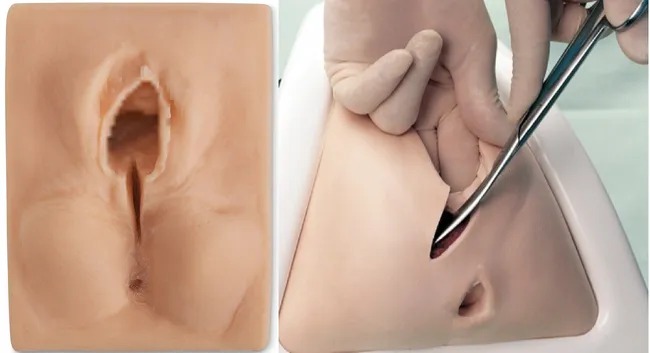 ❌❌Bác sĩ sản khoa nói về nỗi sợ hãi của nhiều chị em mang tên "RẠCH TẦNG SINH MÔN", hóa ra nếu không rạch còn Đáng sợ hơn.😣

"Rạch tầng sinh môn" là một trong những "giai thoại" khiến nhiều chị em đã từng trải qua khi nhắc lại vẫn thấy nổi da gà. Tầng sinh môn là một phần của bộ phận sinh dục nữ, là phần mô nằm giữa âm đạo và hậu môn. Kích thước tầng sinh môn khoảng 3-5cm và đảm nhiệm vai trò quan trọng đối với chức năng sinh sản của người phụ nữ.

Đối với các sản phụ sinh thường, nhất là sinh con so đầu lòng, thường được các bác sĩ chỉ định thực hiện thủ thuật rạch tầng sinh môn. trong lúc chuyển dạ, khi sản phụ có dấu hiệu xuất hiện cơn co bóp tử cung và rặn đẻ, khi cơn co lên đến đỉnh điểm thì nhân viên y tế sẽ cắt một đường nhỏ tầng sinh môn để mở rộng khu vực này, giúp em bé ra ngoài dễ dàng hơn.

Chắc hẳn với không ít các chị em đẻ thường, bên cạnh cảm giác đau đẻ thì cảm giác đau khi rạch, khâu tầng sinh môn và những ngày khi vết khâu chưa lành là một nỗi ám ảnh. Vết khâu tầng sinh môn ảnh hưởng không nhỏ đến cuộc sống của người mẹ sau sinh, từ việc đi lại cho đến việc đi tiểu tiện, đại tiện... đều khá bất tiện. Chính vì điều này mà không ít người thắc mắc: "Tại sao lại phải rạch tầng sinh môn?", "Thời xưa các bà các mẹ ít bị rạch mà bây giờ đa số đều phải rạch?", "Nếu không rạch thì sẽ ra sai?"....

Chia sẻ về vấn đề này, Th.S.BS Việt Cường (phó giám đốc Trung tâm khám và điều trị, chăm sóc sức khỏe sinh sản - Bệnh Viện Phụ sản Hà Nội cơ sở 2) cho biết: "Khi đầu em bé chui vào trong âm đạo của người mẹ để chuẩn bị ra ngoài thì thực tế lỗ mở âm đạo nhỏ hơn đầu em bé, vì vậy việc rạch tầng sinh môn nhằm mục đích để mở rộng khu vực này đồng thời tạo vết rạch theo một hướng định sẵn, tránh rách phức tạp. Rách phức tạp tầng sinh môn có nhiều cấp độ: Rách sâu vào bên trong âm đạo, rách đứt thớ trung tâm bên ngoài, rách cơ thắt hậu môn, rách trực tràng,...

Những ca rách phức tạp tầng sinh môn, phải khâu 1-2 tiếng đồng hồ trong khi nếu là vết cắt chủ động thì việc khâu chỉ mất 10-15 phút. Bên cạnh đó, việc rạch tầng sinh môn cũng làm hạn chế tình trạng mất máu sau sinh vì có nhiều trường hợp mất nhiều máu do rách phức tạp. việc chảy máu ở vùng dưới có thể tạo thành rối loạn đông máu, không cầm máu được, những điều này rất nguy hiểm cho sản phụ.

Hơn nữa, nếu không rạch sẽ làm em bé ra ngoài khó khăn hơn, nguy cơ lớn nhất là khiến bé bị ngạt, khi chào đời không khóc. Vậy nếu đứng trước 2 sự lựa chọn, 1 là rạch, 2 là không rạch đợi âm đạo đủ giãn để bé chui ra nhưng có nguy cơ bị ngạt thì chắc chắn cả sản phụ và bác sĩ đều chọn cách an toàn cho cả mẹ và bé.

 Việc đẻ thường hay đẻ mổ cũng đều có những ưu nhược điểm. Nhưng mục đích của chúng ta là làm sao để em bé ra đời khỏe mạnh chứ đừng quá quan trọng việc phải đẻ bằng phương pháp nào.