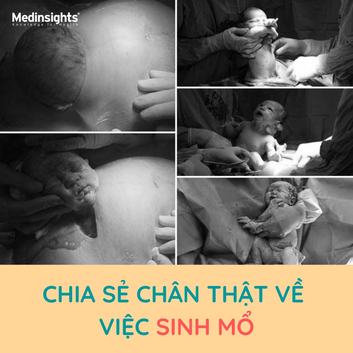 💬 CHIA SẺ CHÂN THẬT VỀ VIỆC SINH MỔ

Khi bác sĩ quyết định tôi phải sinh mổ, tôi đã nghĩ rất đơn giản thế này: “Ngủ một giấc, tỉnh dậy có ngay một đứa con đáng yêu, sướng quá còn gì”. Nhưng sự thật không bao giờ dễ dàng như thế. Chồng tôi đã xin vào phòng mổ để được chứng kiến giây phút con chào đời, nhưng anh ấy đã thấy cảnh ruột của tôi bị kéo ra ngoài, sợ và xót đến nỗi khóc thành tiếng. Còn tôi ư, có nhiều trải nghiệm khó lòng quên được ở một ca sinh mổ!

1️⃣ Rất lạnh

Phòng sinh lạnh, rất lạnh. Tôi nằm đó mà cảm tưởng như mình bị đẩy về phía Nam cực hay Bắc cực rồi. Tôi liên tục run rẩy và nghĩ rằng, bác sĩ gây mê đã quên mình rồi. Trời ơi, có khi nào khi ra khỏi phòng mổ, tôi sẽ bị liệt cả hai chân vì đã chịu lạnh quá lâu không?

2️⃣ Bạn sẽ cảm thấy được tất cả mọi thứ

Bạn sẽ không cảm thấy đau, nhưng cảm giác khi người ta đem con ra khỏi người mình có thể cảm nhận được rất rõ. Ối. “Có thể có một chút áp lực nhẹ”, tôi nghe bác sĩ nói như thế, và rồi, cảm giác như thể một trái bowling nặng trịch nhấc khỏi cơ thể không hề nhẹ đâu bác sĩ à.

3️⃣ Đừng ngại thuốc giảm đau

Phải, sau khi sinh con thành công, tôi cảm thấy rất nhẹ nhàng và khỏe khoắn, thì ra không có gì ghê gớm như người ta vẫn nói. Và “bùm”: hết thuốc mê. Cơn đau xuất hiện một cách đột ngột và làm tôi điêu đứng. Đau, đau lắm. Thực tế là bụng tôi đã bị mổ ra rồi khâu lại cơ mà, da thịt nào chịu nổi chứ?

4️⃣ Khó biểu cảm

Nghe một câu chuyện vui và cố không cười, chỉ nhếch mép thể hiện mình có khiếu hài hước là một trong những thử thách hằng ngày. Bởi lẽ, sau khi sinh mổ, hắt hơi, ho và cười đều đem đến những cơn đau khủng khiếp.

Bởi thế, trong những tháng ngày đó, tôi đã nhận ra một chân lý rằng: “Làm bạn với những người vui tính rất là tốt, nhưng không nên gặp họ sau khi sinh mổ”. Trong trường hợp người vui tính đó là chồng mình, tôi nghĩ cánh phụ nữ nên có biện pháp cảnh cáo và trừng phạt để tránh rơi vào thảm kịch “vừa cười vừa đau”.

5️⃣ Chuyện đi ngoài là bi kịch

Suốt 7 ngày sau khi sinh mổ, tôi không thể đi ngoài được. Bạn có thể tưởng tượng nổi tình cảnh bao nhiêu chất xơ dồn ứ trong ruột không?

Sau đó tôi đã phải nhờ can thiệp y tế và ngồi đồng trong toilet hơn 50 phút để giải quyết hàng tồn đọng. Nếu không, không biết tôi sẽ phải chịu đựng cô nàng táo bón đỏng đảnh đến khi nào nữa.

6️⃣ Khu vực quanh sẹo không có cảm giác

Khu vực quanh vết sẹo mổ của tôi sẽ không bao giờ có được cảm giác nữa. Ở đó có rất ít dây thần kinh và đương nhiên nó sẽ không bao giờ lành lặn lại được. Cùng với những vết rạn da còn mờ mờ, vết sẹo mổ là một trong những “nhân chứng” cho việc trở thành mẹ của tôi.

Đúng là có nhiều điều không hề mong muốn phải gánh chịu khi sinh mổ thật, nhưng tôi đã có một đứa con đáng yêu. Điều này có thể bù đắp cho tất cả. 😍

Vì con yêu mẹ có thể làm tất cả, ba cũng thế nhé hãy yêu thương mẹ và con nhiều hơn ba nhé! 😍

Nguồn: Webtretho
