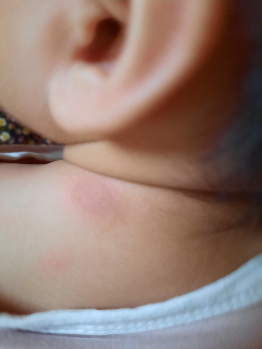 Các mom cho en hỏi có con ai bị như này không ạ. Không biết có phải bị lang ben hay hắc lào không nữa
