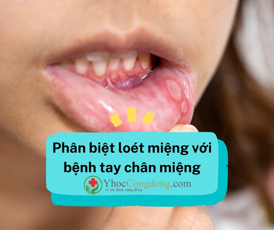 Tránh nhầm lẫn loét miệng với tay chân miệng

👉 Viêm loét miệng và tay chân miệng đều xuất hiện các vết loét đỏ tổn thương ở khoảng miệng. Tuy nhiên, hai bệnh này cũng có những dấu hiệu riêng cho phụ huynh có thể dễ dàng nhận biết.

BSCKII Dư Tuấn Quy - Trưởng khoa Nhiễm - Thần kinh, Bệnh viện Nhi đồng 1 (TP.HCM) cho biết: "Loét miệng, đẹn miệng với tay chân miệng đều có các dấu hiệu xuất hiện trong khoang miệng. Khi loét miệng miệng bình thường các vết loét là áp - tơ và chỉ có 1 vết loét duy nhất. Trẻ cũng có thể bị đau miệng, chảy nước miếng và sốt nhẹ kèm theo. Còn loét miệng do tay chân miệng thì ngoài 1 vết loét sẽ có thêm các vệ tinh, các vết loét, vết chấm loét xung quanh".

Khi phát hiện các vết loét miệng điển hình của bệnh tay chân miệng ở miệng thì cần tìm kỹ ở lòng bàn tay, bàn chân, mông.... để phát hiện thêm những vết loét, ban đỏ khác.

👉 Thời gian gần đây có nhiều trường hợp nổi bóng nước ở các vị trí đặc biệt, kín đáo như rìa ngón tay, kẽ ngón nên chúng ta cần quan sát và chăm sóc trẻ đặc biệt hơn. Cùng với đó phụ huynh phải kiểm tra thử bé có sốt, giật mình hay không.

Phụ huynh cũng cần phải lưu ý vì hiện tượng sốt, biếng ăn, chảy nước miếng của tay chân miệng cũng dễ bị nhầm lẫn với mọc răng.

Theo BS. Quy, bệnh tay chân miệng có hai dấu hiệu quan trọng nhất cần chú ý đó là sốt và giật mình.

👉 Thứ nhất, chúng ta có thể thấy trẻ sốt đột ngột, sốt từ ngày thứ 2 trở lên, sốt cao không hạ, uống thuốc hạ sốt nhưng hết thuốc lại sốt lại, phải sử dụng các loại thuốc hạ sốt khác cùng với chảy nước miếng thì cần chú ý trẻ sốt do tay chân miệng có thể trẻ đang trở nặng lên.

👉 Thứ hai là giật mình, khi trẻ bắt đầu bước vào giấc ngủ, thiu thiu ngủ thì trẻ giật mình, hốt hoảng chới với bắng tay chân lên, đó là dấu hiệu giật mình của tay chân miệng.

Có thêm 1 dấu hiệu nữa của tay chân miệng là bé luôn ôm mẹ bên cạnh, không rời mẹ, khi rời mẹ trẻ sẽ hốt hoảng, chới với.

📌 "Tay chân miệng là bệnh quanh năm, đặc bệt là từ tháng 4 - tháng 6 và tháng 9 - tháng 12. Trẻ đã từng mắc tay chân miệng vẫn có thể tái nhiễm nhiều lần. Những trẻ đã từng mắc sẽ có miễn dịch tự nhiên tuy nhiên miễn dịch này yếu và không có khả năng chống lại virus. Siêu vi trùng đường ruột có rất nhiều loại, có khả năng đợt này trẻ mắc loại này, đợt sau có thể mắc loại khác nên phụ huynh không được chủ quan lơ là" - BS. Nguyễn Minh Tiến – Phó Giám đốc Bệnh viện Nhi đồng Thành phố (TP.HCM) - khuyến cáo.