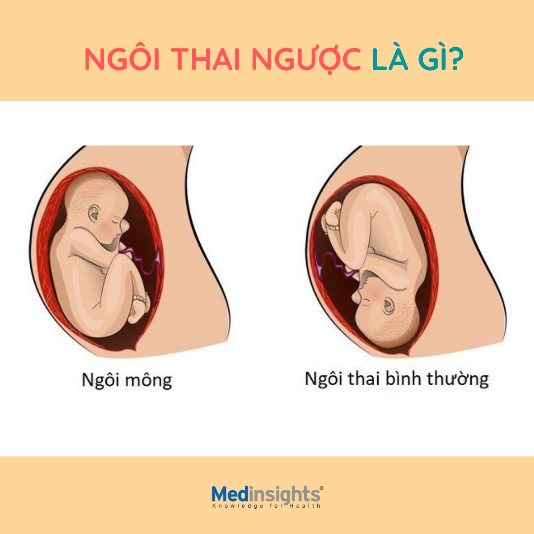 NGÔI THAI NGƯỢC LÀ GÌ?

Ngôi thai là phần trình diện thấp nhất của thai nhi với khung chậu của mẹ, là phần đầu tiên đi ra khỏi bụng mẹ khi chuyển dạ. Trong suốt thai kỳ (khoảng dưới 28 tuần tuổi) thai nhi thường sẽ di chuyển thường xuyên, thay đổi vị trí ở trong bụng mẹ. Càng đến những tuần cuối của thai kỳ, vị trí của thai nhi sẽ bình ổn hơn. Thường thì đến tuần 34-36 trở đi phần lớn ngôi thai sẽ ổn định, ít xoay hướng.

Ngôi ngược hay còn gọi là ngôi mông là phần mông hoặc chân của bé xuống phía dưới, vùng xương chậu của mẹ. Còn đầu của bé sẽ ở phía trên gần ngực của mẹ. Tỷ lệ ngôi mông khá thấp (chiếm từ 1 - 3%) trong các ca sinh nở. Tuy nhiên đây là những trường hợp sinh có thể gây ra nhiều nguy hiểm cho cả mẹ và con.

𝐏𝐡𝐚̂𝐧 𝐥𝐨𝐚̣𝐢 𝐧𝐠𝐨̂𝐢 𝐧𝐠𝐮̛𝐨̛̣𝐜

Ngôi thai ngược được chia thành 2 loại:

Ngôi ngược hoàn toàn: Đầu gối của bé co lại, đùi gập vào người giống tư thế ngồi xổm. Phần mông của bé sẽ đi ra ngoài cơ thể mẹ đầu tiên. Đây cũng là tư thế phổ biến nhất của ngôi thai ngược.

Ngôi ngược không hoàn toàn:

- Kiểu mông: Mông của bé hướng xuống dưới khung chậu của mẹ, 2 chân duỗi thẳng chân vắt ngược lên đầu.

- Kiểu chân: 2 chân duỗi thẳng.

- Kiểu đầu gối: thai quỳ gối trong tử cung.

Nguồn: Vinmec