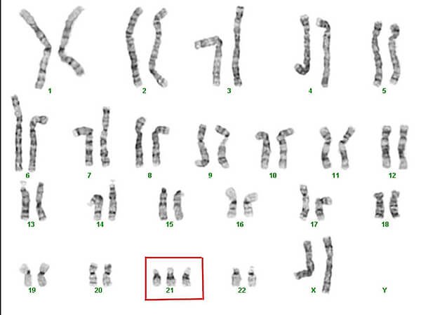 Sự giống nhau và khác nhau giữa xét nghiệm Double test - Triple test