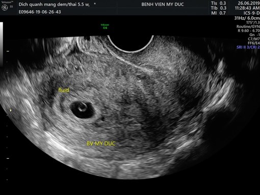 SIÊU ÂM KHI MỚI CÓ THAI – CÂU CHUYỆN NHIỀU TẬP

🔴Tập 1: SIÊU ÂM NGẢ ÂM ĐẠO

Một cô gái trẻ trễ kinh 2 tuần, thử que 2 gạch, đi khám vì ra huyết. Cô thì không có gì, nhưng mẹ nhất định không cho siêu âm ngả âm đạo. Bác giận bác sĩ vì “chọt cái cây đó vô còn gì là thai”. Oan thiệt chớ! Nếu mà siêu âm gây sẩy thai, hư thai thì chắc chắn không ai can đảm làm cô ơi! Nếu lỡ thai ngoài tử cung mà phát hiện trễ, lúc đó lỗi tụi con lớn lắm, nên cô cứ an tâm. Vậy mà, cô vẫn không an tâm!!!

🟠Tập 2: Bóc tách, tụ dịch, động thai

Đang yên đang lành, đi siêu âm xong về không dám nhúc nhích. Túi thai tụ dịch 30%, 40%, nguy cấp lắm rồi. Nếu mà có ra máu nữa thì tình hình vô cùng bi đát!!!
KHÔNG – MỘT NGÀN LẦN KHÔNG

Lớp dịch phản âm kém lượng ít dưới màng đệm có thể là dịch sinh lý ở thai giai đoạn sớm, khác với khối máu tụ dưới màng đệm. Còn nếu có xuất huyết dưới màng đệm, thì mối tương quan giữa khối xuất huyết này và kết cục thai kỳ hiện vẫn chưa rõ. Có thể có kết cục bất lợi nhưng cần nghiên cứu thêm, có thể không liên quan sẩy thai đáng kể. Ngoài ra, không có chỉ định nằm bất động trong trường hợp này, vì không cải thiện tình hình, ngược lại có khi gây hại thêm, ví dụ như tắc mạch, rất mệt mỏi, stress v.v…
Vì vậy, nếu lỡ có thấy xuất huyết dưới màng đệm, hít một hơi thật sâu, rồi tự nhủ “khoa học chưa rõ ràng, thôi mình không cần lo nữa, cứ theo dõi tiếp thôi”.

🟢Tập 3: tim thai

Mọi chờ mong siêu âm đầu thai kỳ là nhịp tim đập của em phôi bé bỏng. Em phôi nhỏ xíu như hạt mè, hạt đậu, vậy mà tim nhấp nháy liên hồi. Thấy được tim thai, là thấy sự sống rõ ràng hiển hiện.

Hoạt động tim thai có thể thấy từ tuần thứ 6 của thai, khi chiều dài đầu mông của phôi (CRL) khoảng 1,5 – 2mm. Khi phôi khoảng 2-4 mm, có khoảng 5-10% trường hợp phôi sống chưa thấy hoạt động tim thai. Vì vậy, nếu chưa thấy tim thai, có thể chờ đợi thêm. Ngoài ra, cũng như người lớn mình, tim thai không là con số hằng định, có thể lần này siêu âm ra tần số khác, hôm sau khác, miễn là trong giới hạn bình thường, tùy giai đoạn phôi thai.

‼ Gọi là tim thai chậm khi:
+ CRL 1-4 mm: tim thai chậm khi <90 l/p, giới hạn: 90-99 l/p
+ CRL 5-9mm: tim thai chậm khi < 110 l/p, giới hạn: 110-119 l/p

Tim thai giai đoạn phôi thai chỉ có ý nghĩa duy nhất -  là sự sống. Không thể dự đoán thai tốt hay không tốt, bình thường hay dị tật, con trai hay con gái.

🆘Các dấu hiệu tiên lượng không tốt:

Túi thai không đều, nằm thấp; vôi hóa noãn hoàng (yolk sac), túi ối trống, tim thai chậm ≤85 lần/phút, khối xuất huyết lớn; đường kính túi thai nhỏ, tương quan giữa túi thai và phôi (MSD – CRL) <5mm.

Mình có 1001 câu chuyện liên quan đến siêu âm thai sớm này, nhưng thật lòng mình muốn nói chỉ một điều duy nhất: không có bác sĩ Sản khoa nào thấy dễ chịu khi nói rằng em bé có thể không giữ được, không bác sĩ Sản khoa nào thấy thoải mái khi tư vấn “hay mình dừng theo dõi thai nha, không còn hy vọng”, không hề có. Y khoa sẽ có những chuyện khó mà giải thích hay lý giải, nên nhiều lúc cũng suy nghĩ bâng quơ vài ngày, rồi thôi.

Hai cái hình bên dưới, nếu là bệnh nhân, thì khó mà hiểu hết. Nhưng nếu hỏi cái nào tiên lượng tốt hơn, câu trả lời “không biết đâu”, có nhiều chuyện trên đời, thấy vậy mà không phải vậy!!

Bs. Lê Tiểu My