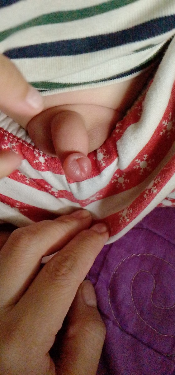 các mom ơi..có mom nào có bé bị bọ đỏ cắn ở chim bé mà bị sưng to lên k ạ..hwa mjk có lấy con bọ đỏ ra rồi mà nay vẫn sưng vậy..giờ k bít lms nữa ạ