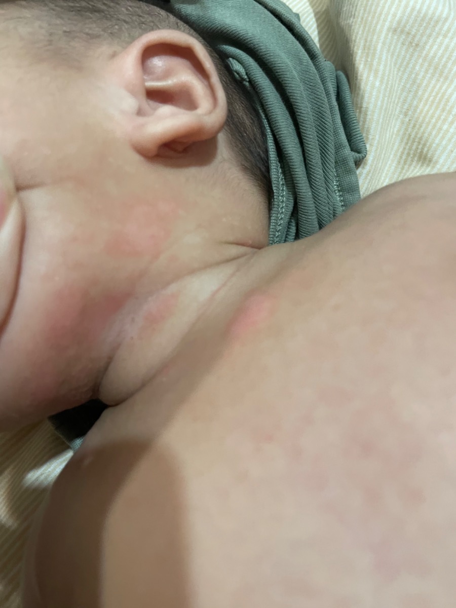 E muốn hỏi có mom nào có con bị vậy k ạ bé nhà e 2m10d ạ