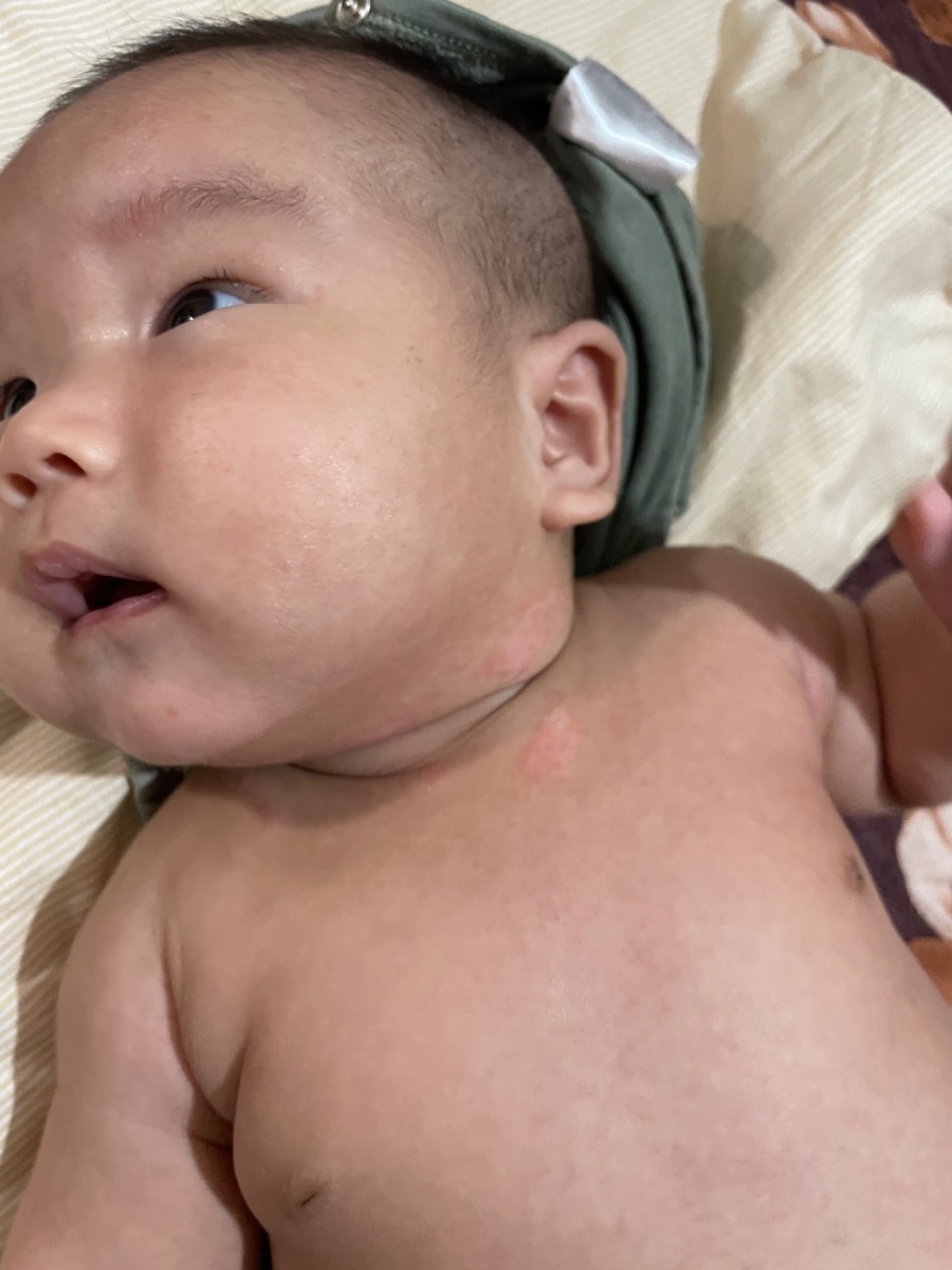 E muốn hỏi có mom nào có con bị vậy k ạ bé nhà e 2m10d ạ