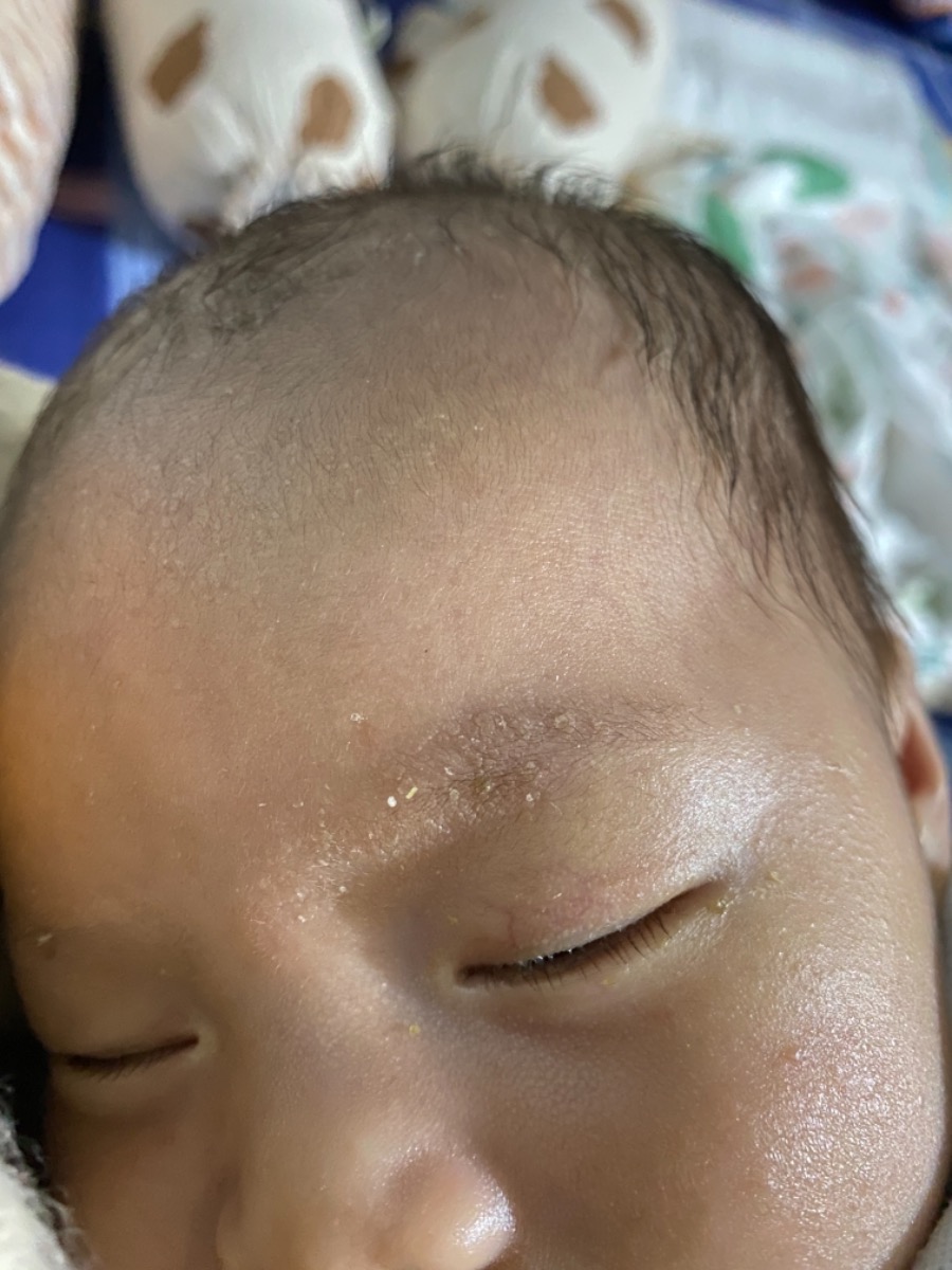 cho e hỏi bé nhà e bị gì ở lông mày ạ, hôm tắm e có lau sạch rồi giờ bị lại