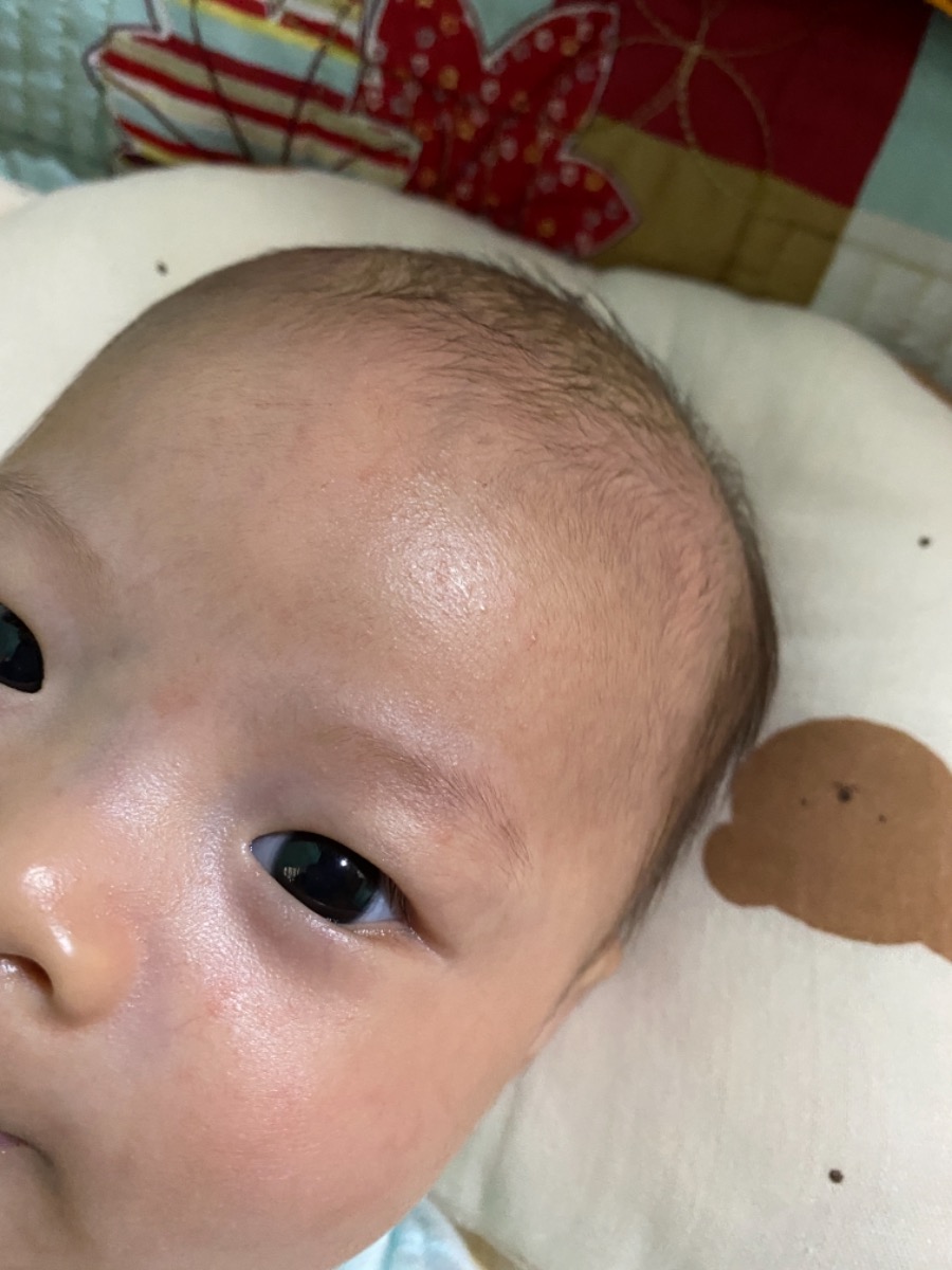 bé nhà mình nổi hạt đỏ li ti này có phải là rôm sảy ko ạ