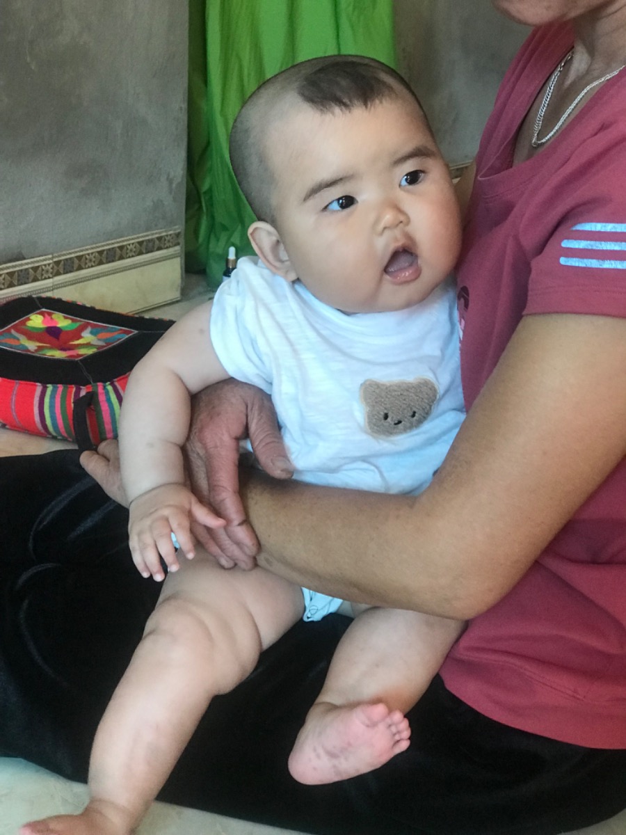 Chân con em từ lúc đẻ ra đã có rãnh như vậy liệu có sao không ạ