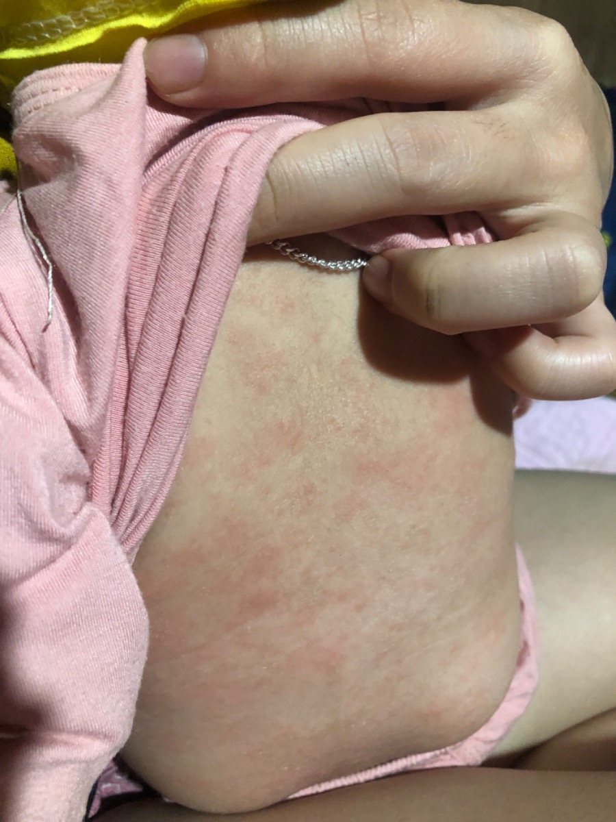 Chào ad và các bố mẹ. Em bé nhà mình hiện tại 3 tháng tuổi. Từ lúc sinh bé có nốt đỏ bs bảo viêm da ( yêu cầu thay nước giặt cho bé ), về nhà mình có tắm , bôi đủ loại lá đắng, chát cho con.  đến 1 tháng tuổi được bs kê 1 lọ kem bôi da. Mình có bôi và nút đỏ lặn ngay sau bôi vào tiếng đồng hồ. Nhưng lặn 3-4 hôm nút lại lên mình có duy trì bôi cho con vài lần lặn lại lên đến 2 tháng mình ngừng.nhiều người bảo lớn tí sẽ tự khỏi.  Hiện tại con nổi mẩn nhiều và lan khắp người không thấy đỡ. Trước khi đi bs lần nữa. Em muốn hỏi ad, hỏi  xem có bố mẹ nào có con bị giống bé không ạ ? Cho em xin giải pháp với ạ