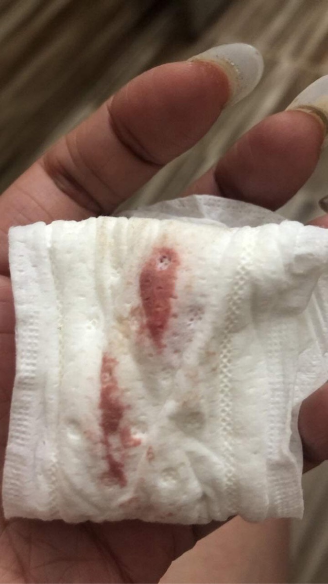 2 tuần này nhạy cảm mùi, nhức nửa đầu, chóng mặt, buồn ngủ, từ k biết ăn cay nay ăn quá cay, trễ kinh 5 ngày thì xuất hiện vệt màu đỏ Hồng nhạt (do uống nhiều nước dừa ) em bị sao vậy ạ