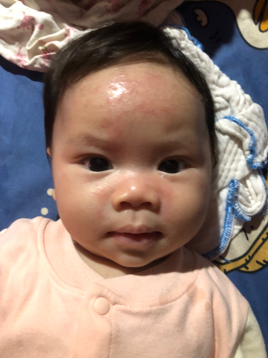 Chào ad và các bố mẹ. Em bé nhà mình hiện tại 3 tháng tuổi. Từ lúc sinh bé có nốt đỏ bs bảo viêm da ( yêu cầu thay nước giặt cho bé ), về nhà mình có tắm , bôi đủ loại lá đắng, chát cho con.  đến 1 tháng tuổi được bs kê 1 lọ kem bôi da. Mình có bôi và nút đỏ lặn ngay sau bôi vào tiếng đồng hồ. Nhưng lặn 3-4 hôm nút lại lên mình có duy trì bôi cho con vài lần lặn lại lên đến 2 tháng mình ngừng.nhiều người bảo lớn tí sẽ tự khỏi.  Hiện tại con nổi mẩn nhiều và lan khắp người không thấy đỡ. Trước khi đi bs lần nữa. Em muốn hỏi ad, hỏi  xem có bố mẹ nào có con bị giống bé không ạ ? Cho em xin giải pháp với ạ