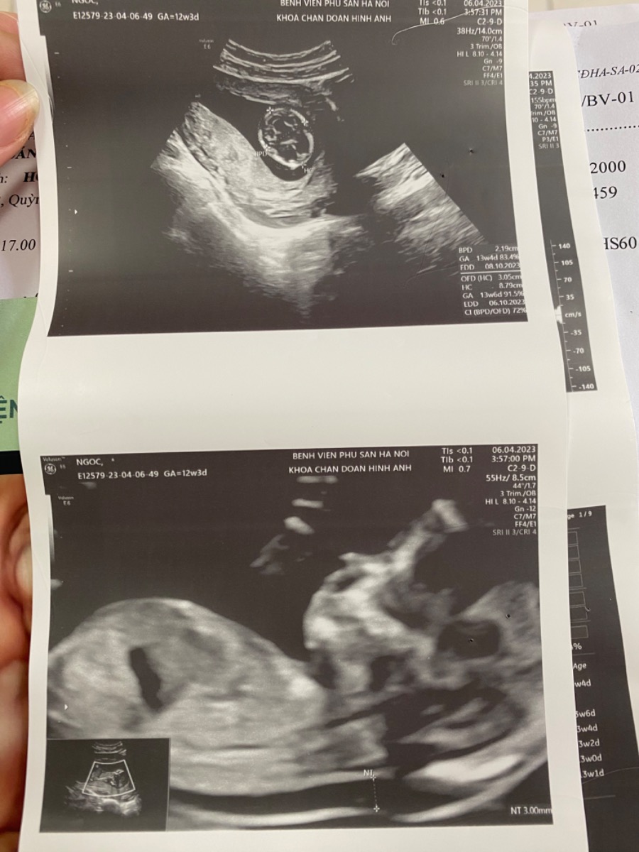 Tuần 13 e có đi siêu âm, bác sĩ bảo độ mờ da gáy 3mm, vậy nguy cơ dị tật thai nhi có cao k ạ