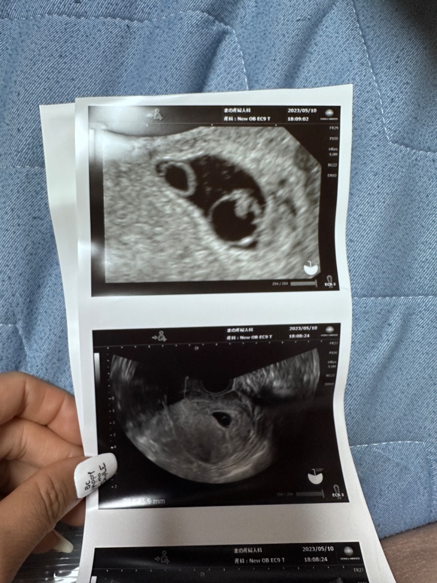 Chào bác sỹ!
Em muốn hỏi là khi con được 6 tuần tuổi em siêu âm có thấy tim thai, nhưng hôm nay con được 8 tuần thì lại không thấy tim thai và bác sỹ có nói là thai không phát triển, khả năng lớn là sảy thai tự nhiên. Khi siêu âm, bác sũ còn thấy có 2 hình tròn trong tử cung, bác sỹ cũng chưa xác định được và hẹn  em mấy ngày sau quay lại khám. Em thật sự rất lo lắng. Xin bác sỹ cho em lời khuyên ạ!
Em xin cảm ơn!