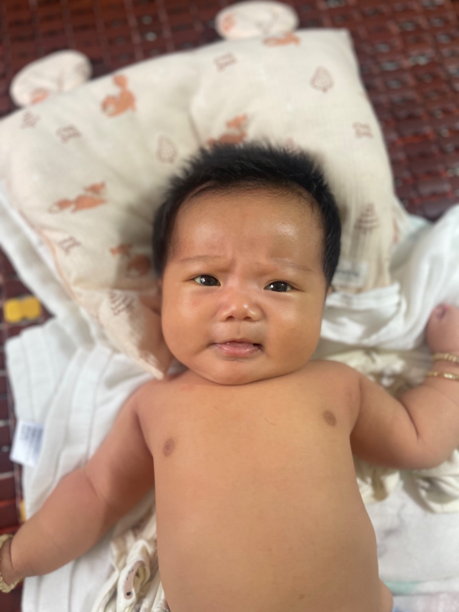 Bé nhà em 2tháng rồi vẫn bị vàng da ở khoé mắt và một ít ở ngực. Lòng bàn tay và bàn chân bé không có. Theo quan sát bé có giảm dần, nhưng chậm.
Bé sinh 39w, nb 4,4kg.
Bs cho em hỏi, vậy có nguy hiểm không?
Có cần đi chiếu đèn không?
Bé bú mẹ hoàn toàn.
Mẹ ăn carot, bí đỏ, đủ đủ có ảnh hưởng vàng da cho bé không ạ?