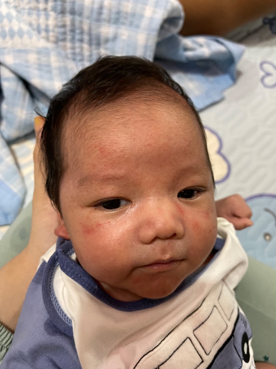 Con em mặt bị như thế này là sao hả các mom. Các mụn đỏ li ti li ti nhiều lắm ạ???