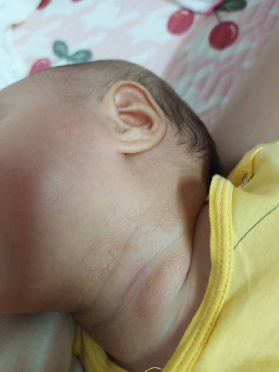 Bé nhà e được 2 tháng 17 ngày. Cổ bé dạo này mọc rất nhiều nốt ạ. A/c cho e hỏi đây là nốt gì vậy ạ? Và bôi gì để con nhanh hết ạ. E cảm ơn!