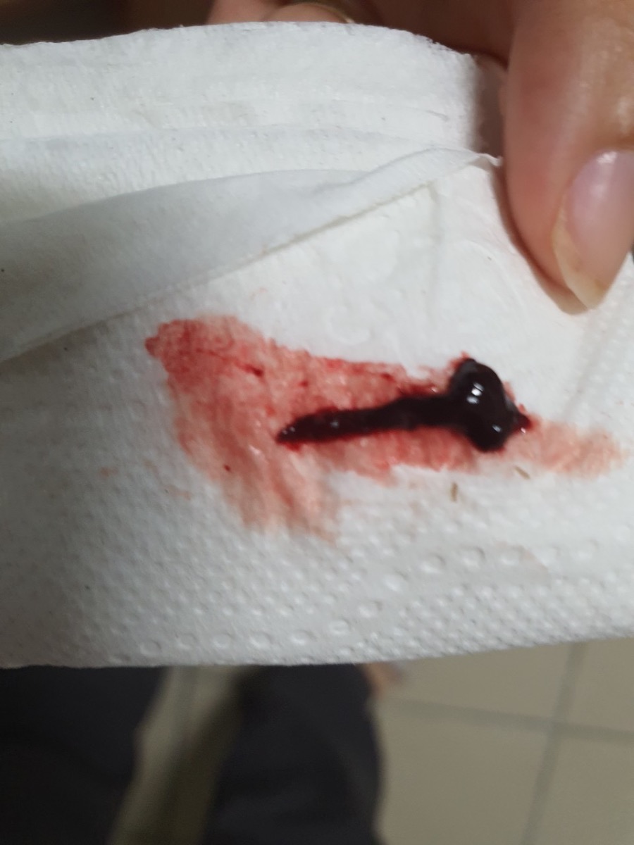 Cho em hỏi nay em có thai dc 7 tuần nhưng đi vệ sinh ra máu cục mà không đau bụng liệu em bé của em có sao không ạ. Em cảm ơn