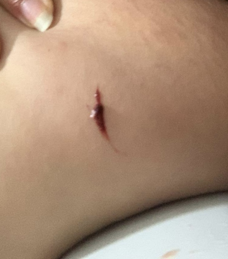 Chào ad, mình vừa đi vsinh sau 1 đêm ngủ thì thấy nc tiểu có màu hơi hồng và thấy nhỏ giọt trên bồn cầu cũng chỉ hơi hồng, mình thấy bị hơi buốt bụng dưới chắc là do ebe quay đầu. Kèm theo đó mình thấy một xíu như ảnh này dính ở đùi ngay gần âđ (ảnh đã cắt), ad tvan giúp mình nên làm tnao ạ?