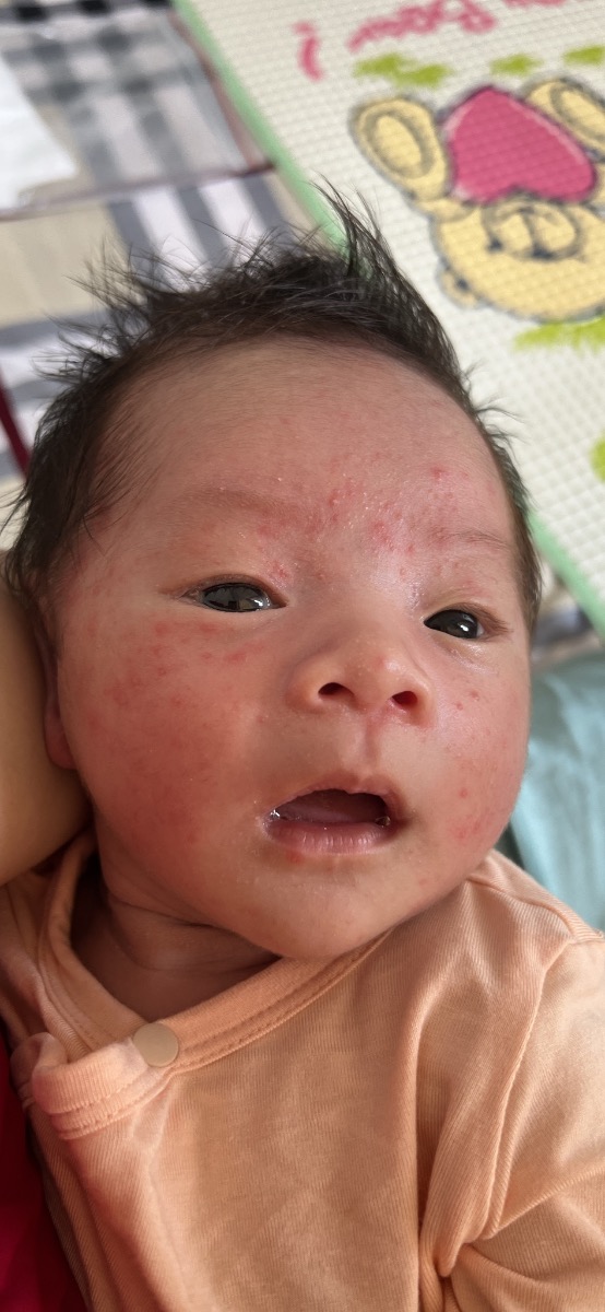 Em chào BS ạ
Em có 2 vấn đề cần nhờ tư vấn ạ.
1. Bé nhà em sinh thường tới nay được 20 ngày nhưng cách đây khoảng 4 ngày bé bắt đầu nổi những mụn li ti trên mặt! Sau lan ra sau gáy và tới nay lên khắp đầu và lưng, rất nhiều mụn li ti đầu trắng, xung quanh đỏ gần như mỗi 1 chân tóc 1 mụn! Hiện tại bé ti mẹ hoàn toàn. Do em bị rách vết khâu tầng sinh môn nên đến hiện tại em vẫn đang dùng thuốc Katrypsin 8400iu và Cledomox 1000. 
Nhờ BS tư vấn giúp em bé bị vậy có sao không ạ? Và em cần làm gì để bé nhanh hết ạ? Em thấy bé ngứa ngáy khó chịu tội quá ạ.
2. Em sinh bé đc 20 ngày rồi mà sản dịch ra vẫn máu đỏ tươi và gần như lúc đến tháng! Em không bị sốt hay sản dịch có mùi hôi! Bác tư vấn giúp em ra như vậy có ảnh hưởng gì k ạ? Và cần làm gì để nhanh hết sản dịch ạ!
Em cảm ơn nhiều ạ?