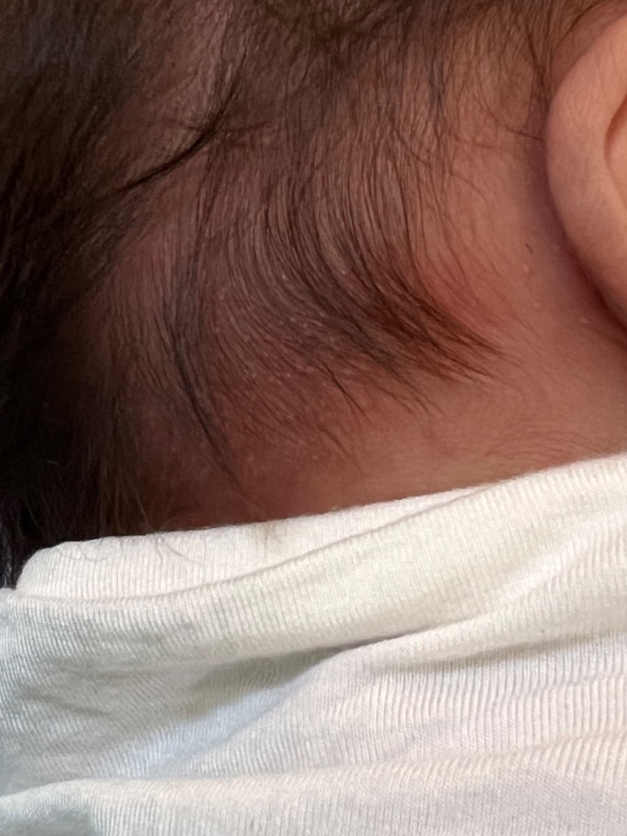 Em chào BS ạ
Em có 2 vấn đề cần nhờ tư vấn ạ.
1. Bé nhà em sinh thường tới nay được 20 ngày nhưng cách đây khoảng 4 ngày bé bắt đầu nổi những mụn li ti trên mặt! Sau lan ra sau gáy và tới nay lên khắp đầu và lưng, rất nhiều mụn li ti đầu trắng, xung quanh đỏ gần như mỗi 1 chân tóc 1 mụn! Hiện tại bé ti mẹ hoàn toàn. Do em bị rách vết khâu tầng sinh môn nên đến hiện tại em vẫn đang dùng thuốc Katrypsin 8400iu và Cledomox 1000. 
Nhờ BS tư vấn giúp em bé bị vậy có sao không ạ? Và em cần làm gì để bé nhanh hết ạ? Em thấy bé ngứa ngáy khó chịu tội quá ạ.
2. Em sinh bé đc 20 ngày rồi mà sản dịch ra vẫn máu đỏ tươi và gần như lúc đến tháng! Em không bị sốt hay sản dịch có mùi hôi! Bác tư vấn giúp em ra như vậy có ảnh hưởng gì k ạ? Và cần làm gì để nhanh hết sản dịch ạ!
Em cảm ơn nhiều ạ?