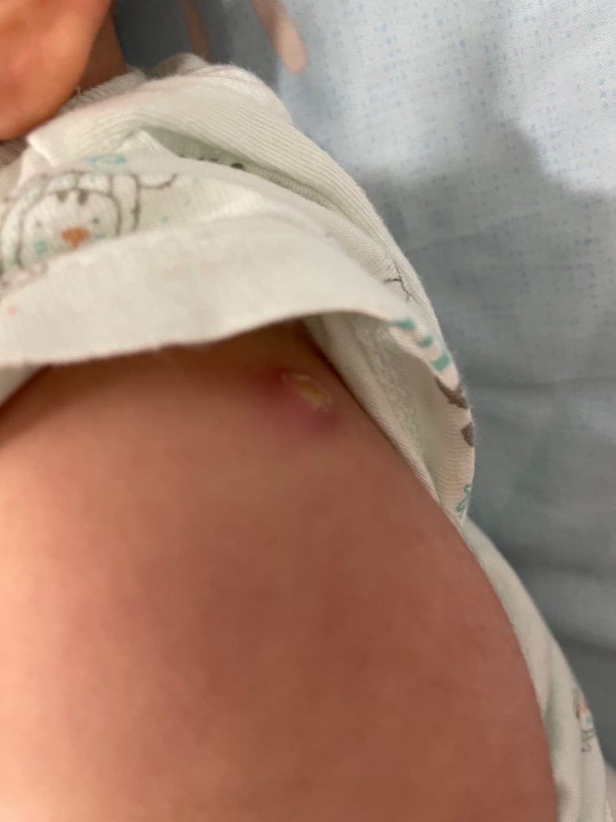 Cho mẹ hỏi, em bé sinh tới nay là hơn 2 tháng,
Sáng nay thấy vết tiêm viêm gan B, mũi một tiêm sau sinh nó sưng và có mủ. 
Cho em hỏi tình trạng này là sao, có nguy hiểm ko?
Và có cần đi bv ko ạ.
Vì mũi tiêm đã hơn 2 tháng rồi.