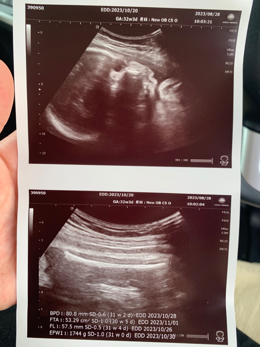 Chào Admin !
Bé con nhà e Hnay did khám ở Nhật 32w3d mới được 1744gr như hình thì liệu có bé quá k ạ ! Với trong tuần này bé con nhà e đầu vẫn nằm trên và nghiêng bên phải thì liệu ít tuần nữa có dễ quay đầu thuận ngôi để sinh thường k ạ ! Khám ở bên Nhật cũng hơi lo lắng 1 xíu ạ ! Admin tư vấn giúp e !