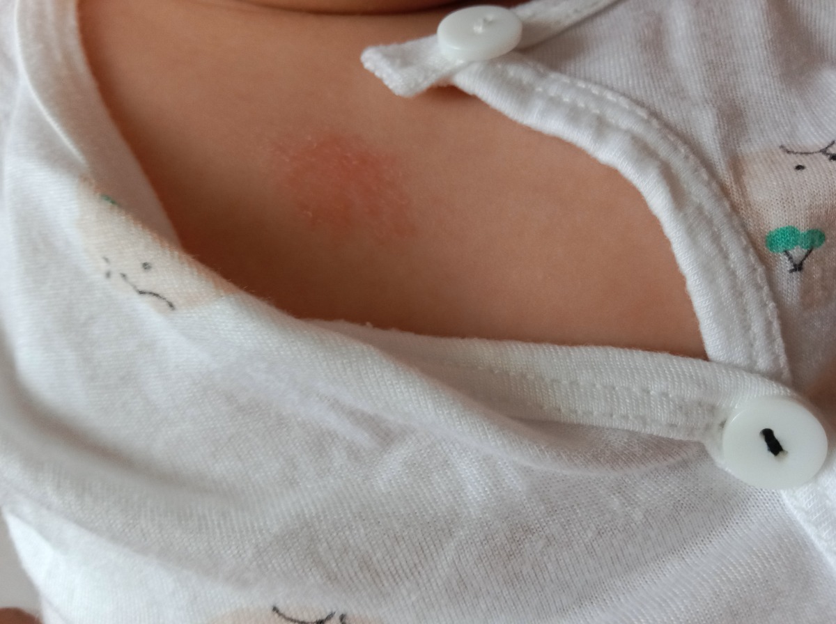 Em chào anh chị ạ
Bé em hơn 3tháng tuổi, em có dùng tinh dầu lợi an để giữ ấm cho bé khi nằm điều hoà. Mấy nay em thấy có chổ da bé đỏ lên như bị bỏng.
Anh chị cho em hỏi nếu bỏng da thì bôi kem sudocream có được không ạ, hay làm thế nào để không bị sẹo.
Nhờ anh chị tư vấn, em cảm ơn anh chị ạ.