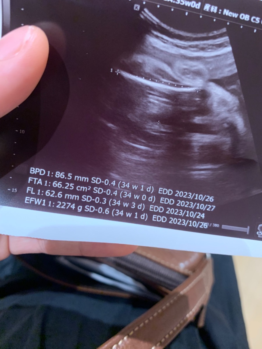 Admin ơi e hỏi ! Hnay e tuần 35 vừa đi khám xong thì theo chỉ số như ảnh thì có vấn đề gì k ạ ? 
Trọng lượng tnay có bé quá k ạ