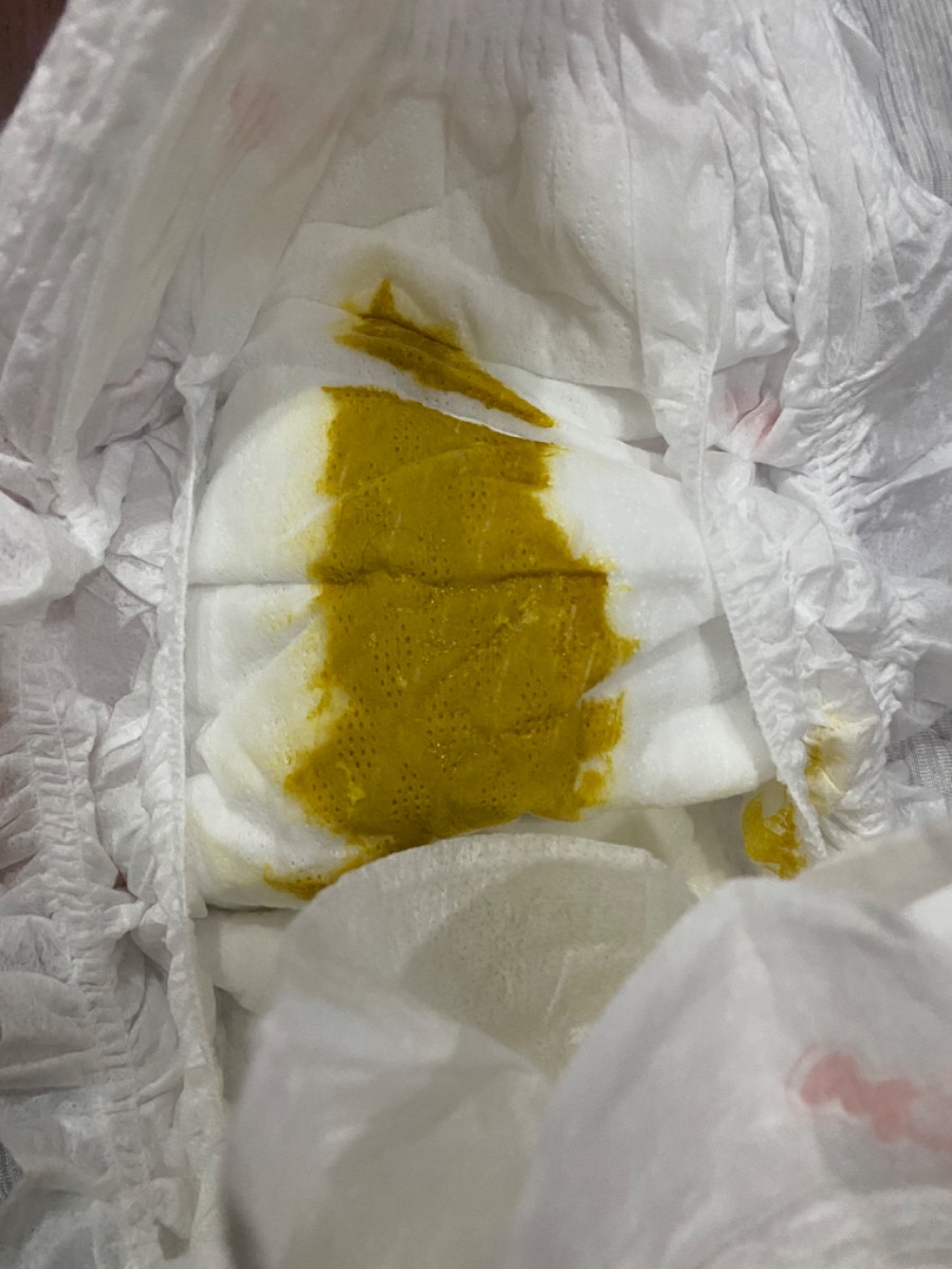 E chào bác sĩ ạ, bé nhà e hơn 4th, bé bú sữa mẹ và 1 cử meiji vào tối, lúc trước tình trạng đi ngoài của bé rất ổn, phân vàng dẻo đẹp và trộm vía ngày nào cũng đi, lâu lâu thì 2-3 ngày mới đi nhưng sau đó lại ổn lại, nhưng hơn 1 tuần nay, tình trạng đi ngoài của bé rất bất ổn, 4-5 ngày đi khi đi thì đi 2 -3 lần, có lần lỏng có lần sệt, hôm nay bé tiếp tục đi phân lỏng vàng k nhầy, và chiều nay bé bị són ít phân. Cho e hỏi là do bé không hạp sữa meiji dẫn đến táo bón và tiêu hoá k ổn định đúng k ạ, e có nên đổi sữa cho bé k ạ, và khi đổi e nên đổi sang loại sữa nào ạ? Vì bé nhà e chỉ dặm 1 cử sct thôi nên e cũng lăn tăn lắm