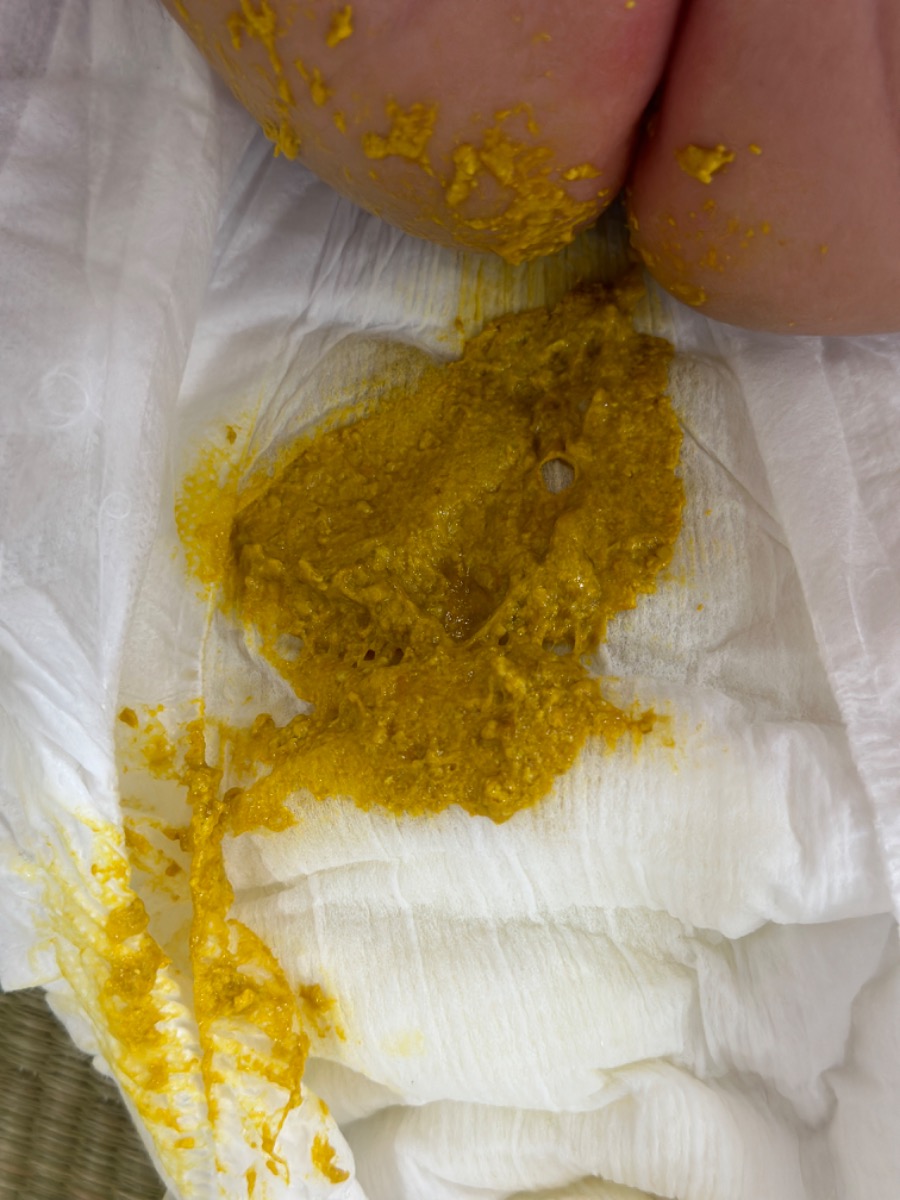 Bé nhà e 2,5m ti mẹ và dặm sữa ct thì phân ntn có vde gì